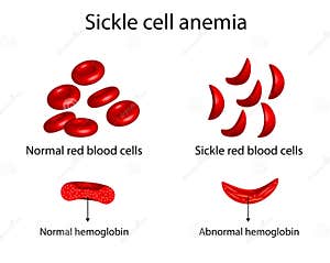 Anemia Sickle Cell Disease Cartoon Vector CartoonDealer 258460077