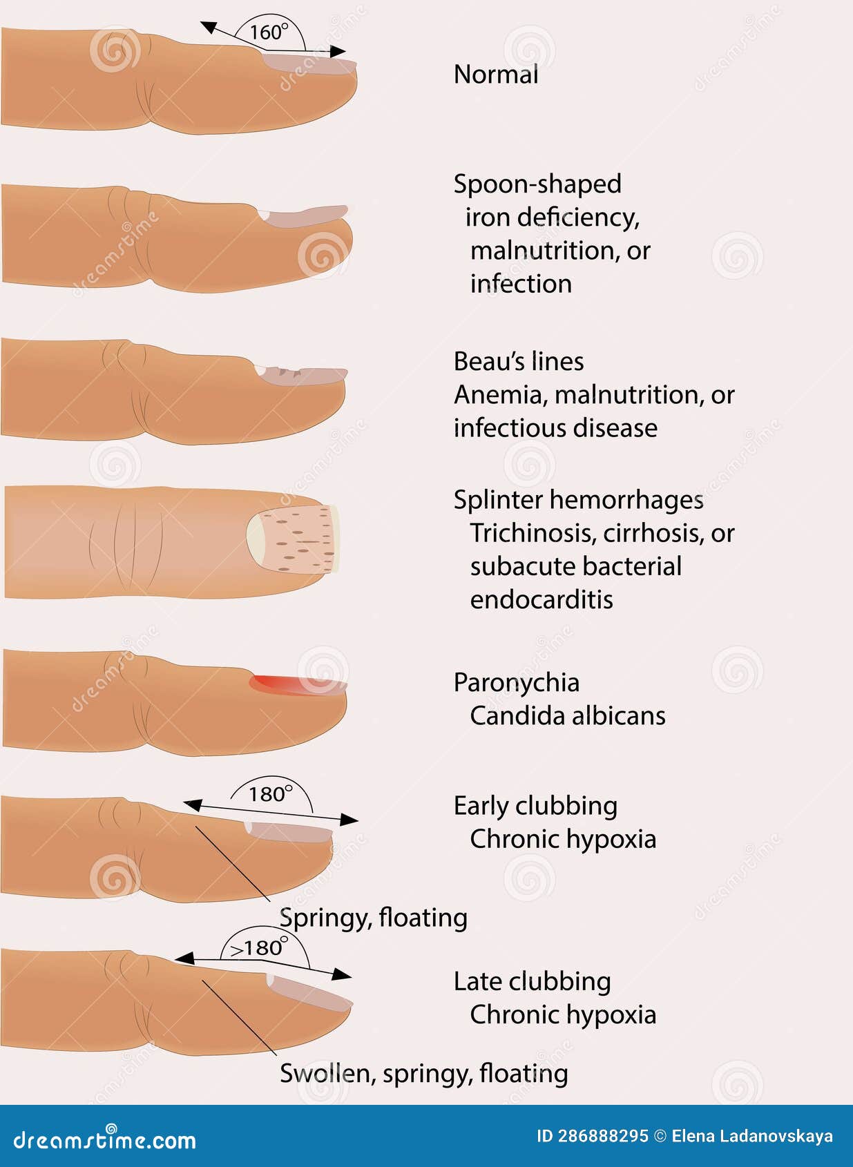 Nail Disease Information Poster for Podiatrists Stock Vector