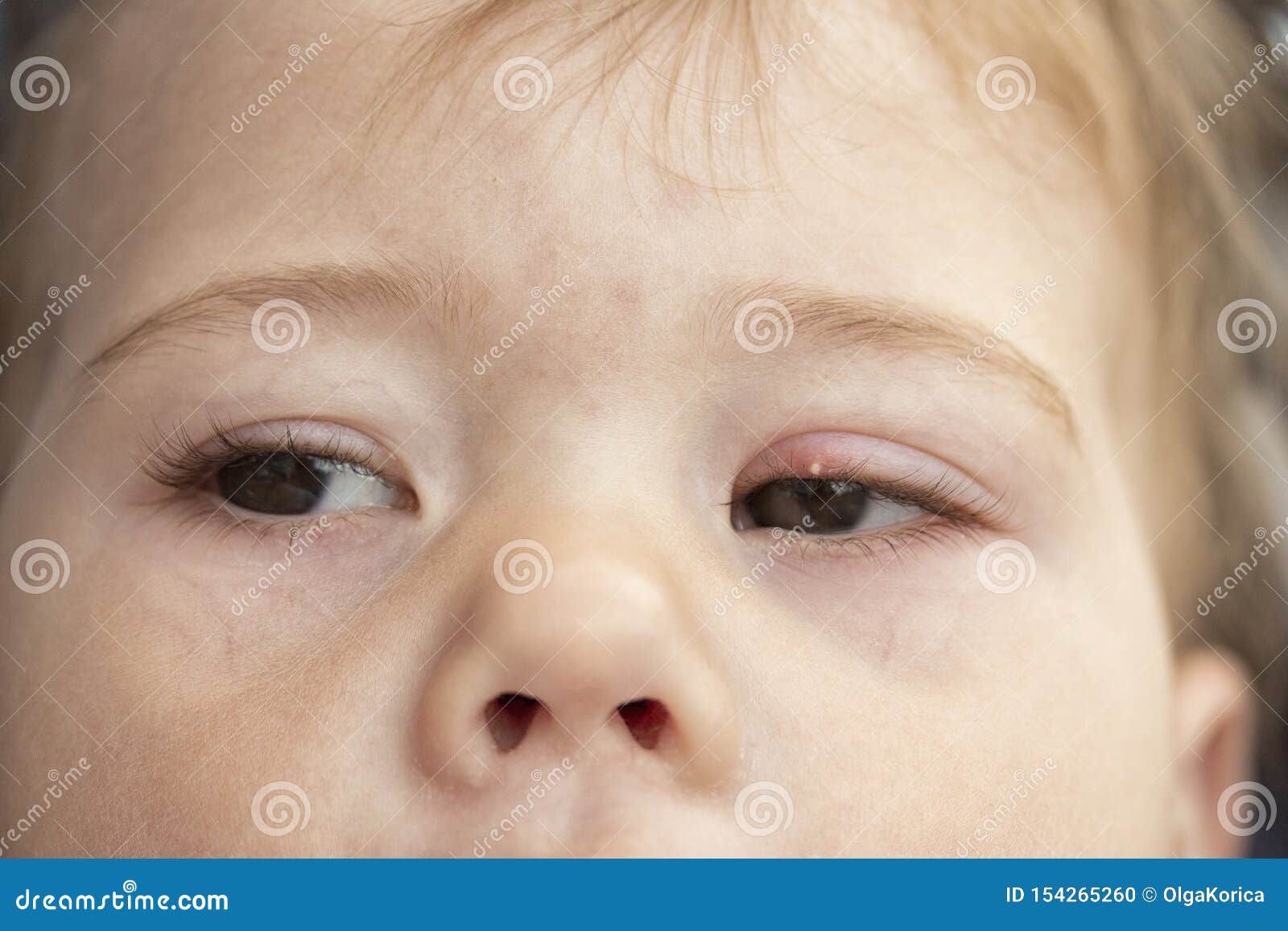 Weisser Pickel Auf Dem Oberen Augenlid Des Auges Milium Entzundung Des Auges Eines Kleinen Babykindes Bindehautentzundung Milium Stockfoto Bild Von Milium Weisser