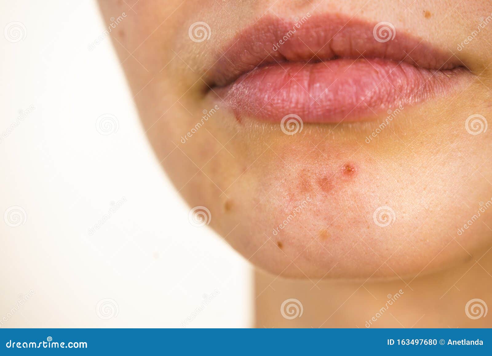 Weibliches Gesicht Mit Akne Hautproblemen Stockfoto Bild Von Haut Sonderkommando