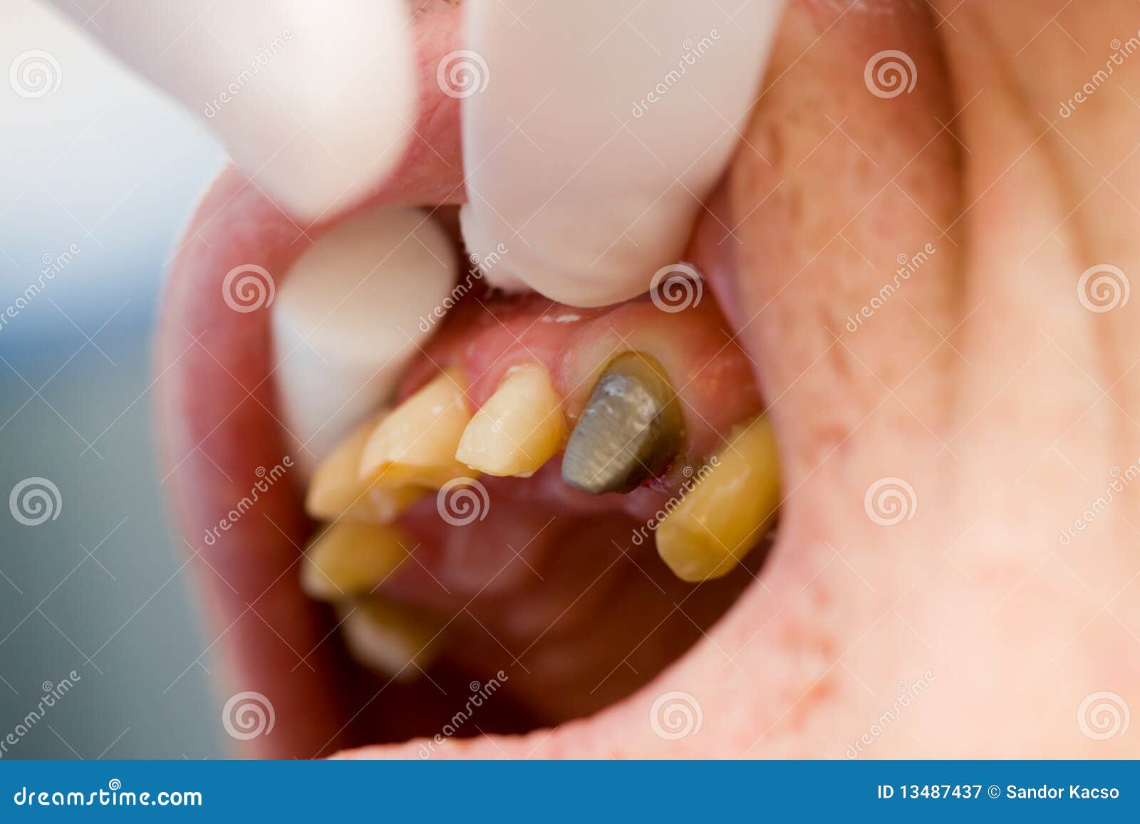 Dental Cord Placing In Gingival Sulcus RoyaltyFree Stock Image