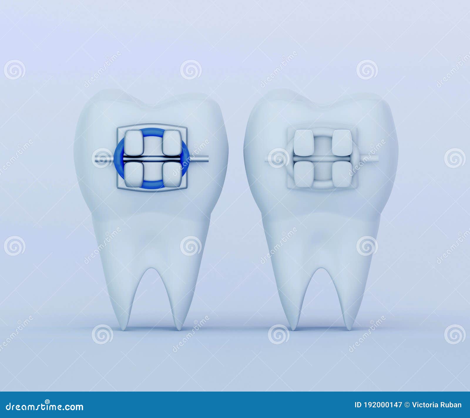 Tooth with Metal Braces and Tooth with Ceramic Braces Stock