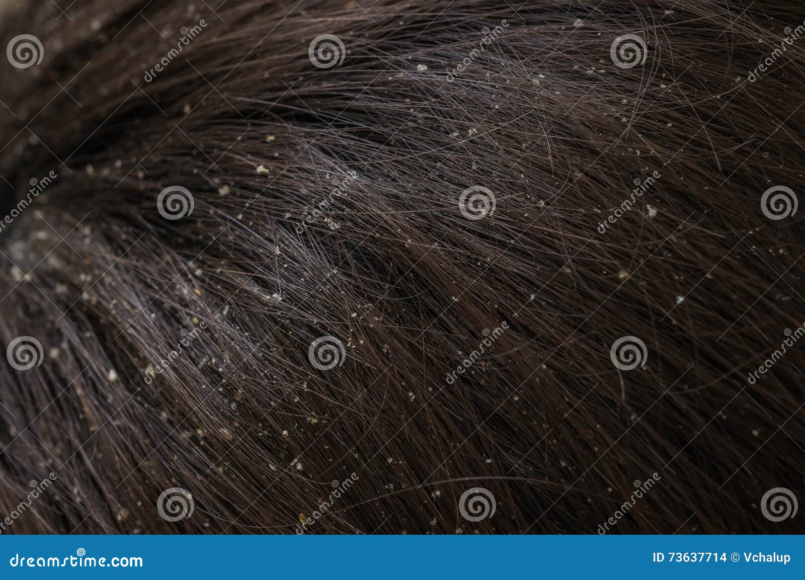 White Dandruff Flakes In Dry Hair On Head Stock Photo Image Of