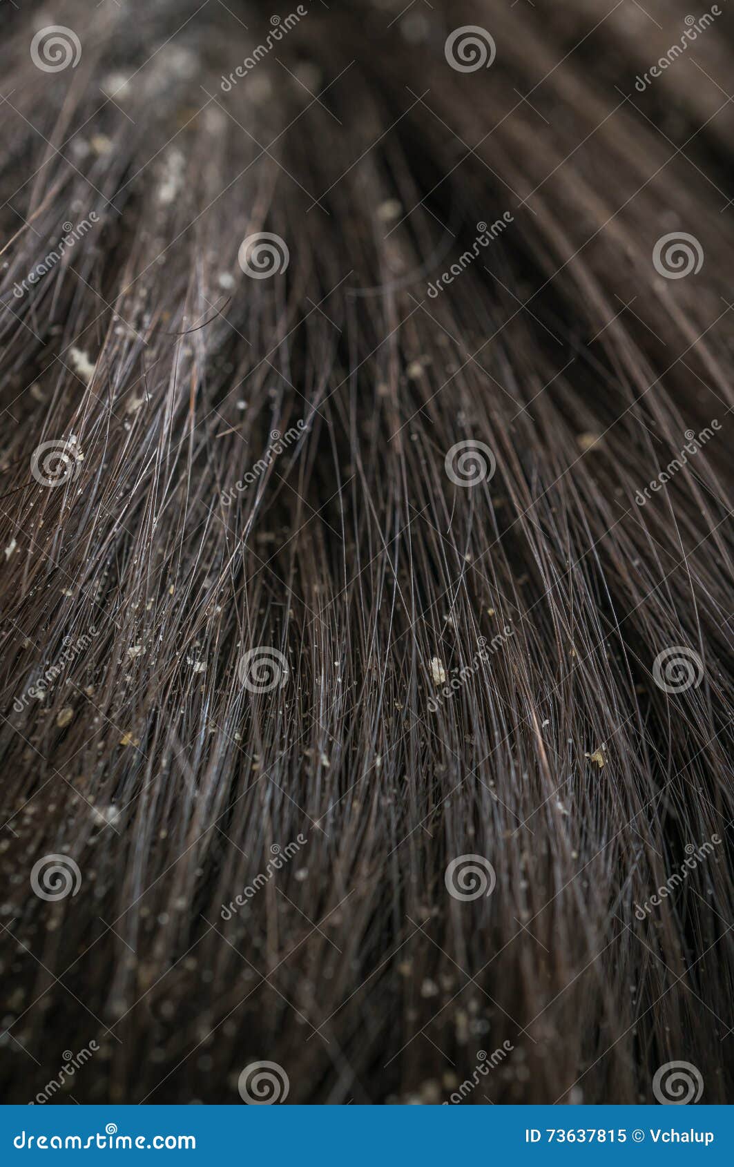 White Dandruff Flakes In Dry Hair On Head Stock Image Image Of