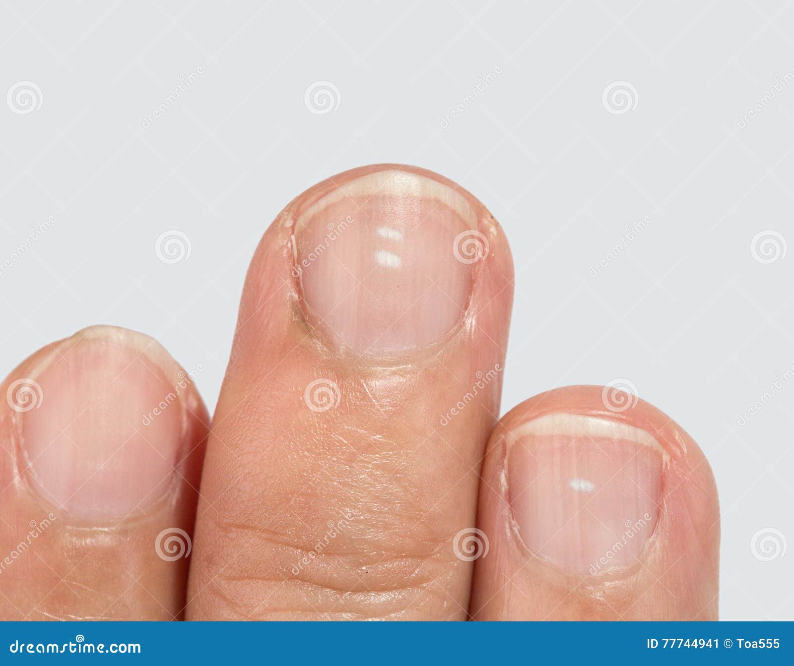 white spots on fingernails