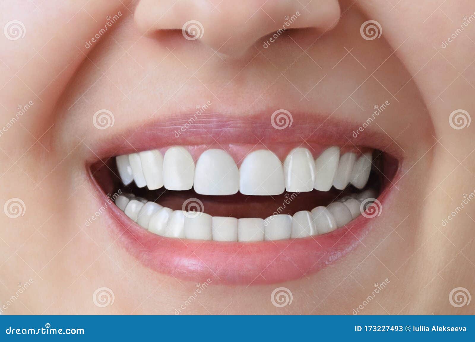 white teeth of a caucasian woman after treatment and whitening of teeth, dental crowns.