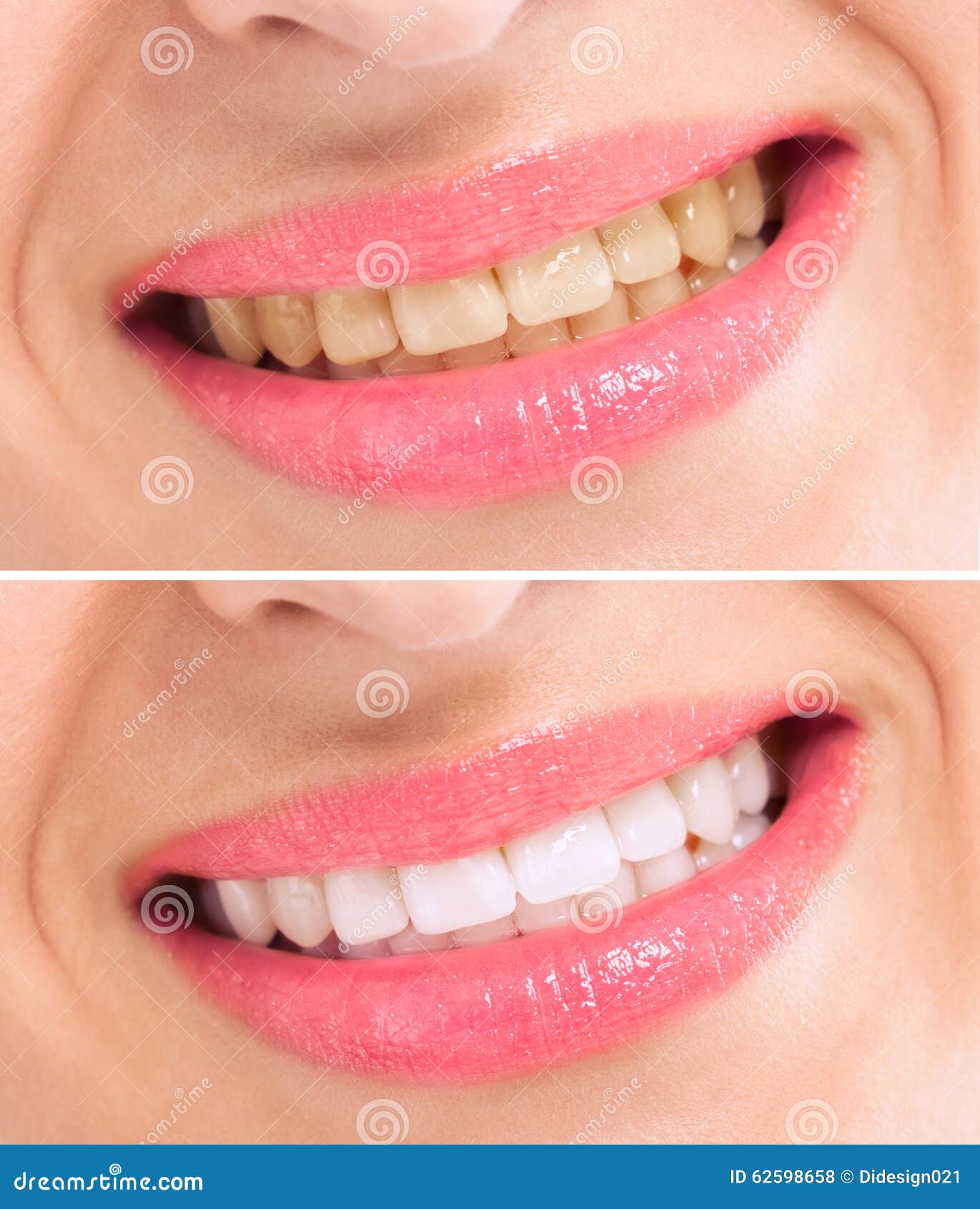 Before and after Whitening Treatment Teeth Stock Photo Image of lady