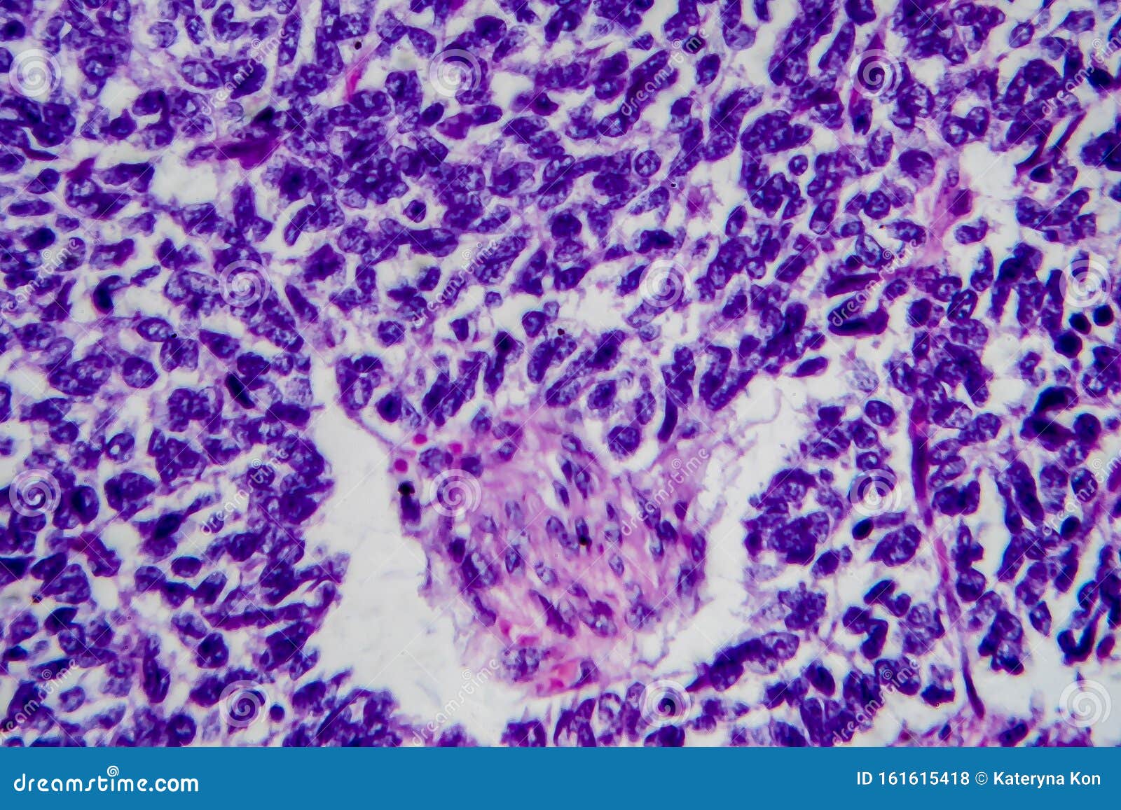 wilms tumor, light micrograph