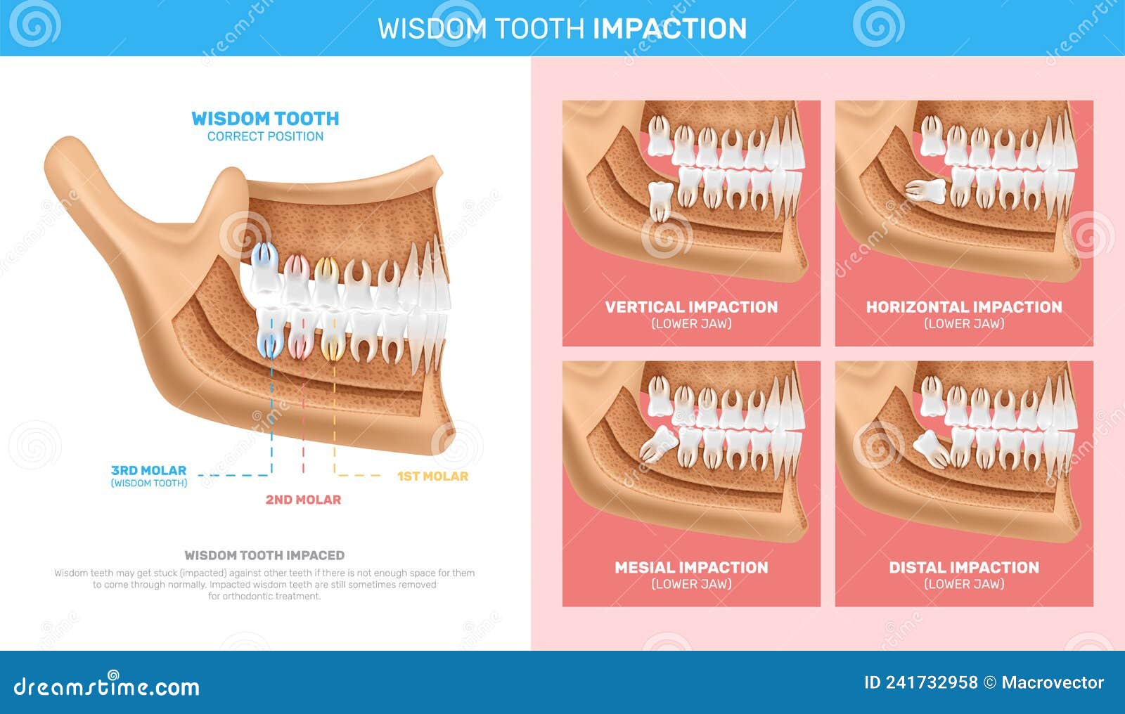 Wisdom Tooth Impaction Infographics Stock Vector Illustration of bone