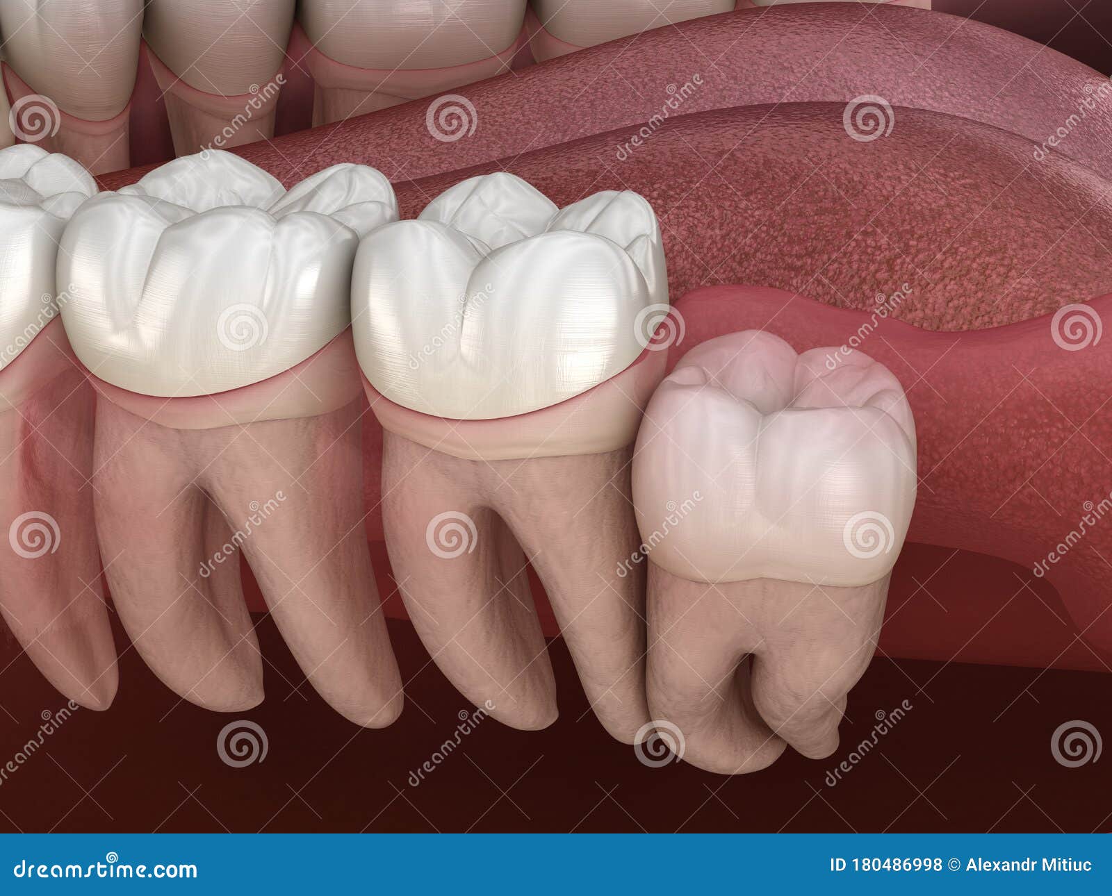 Wisdom Tooth Pushing Adjacent Teeth, Wisdom Tooth Problem. Teeth Row