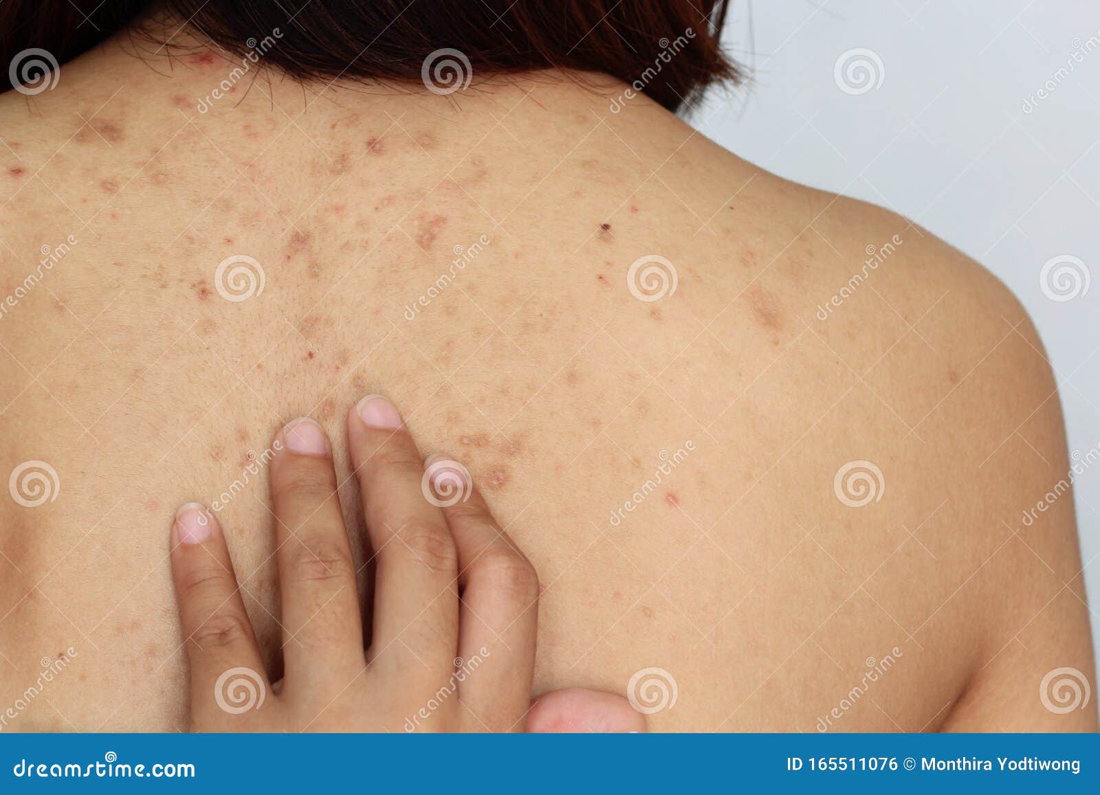 back acne images