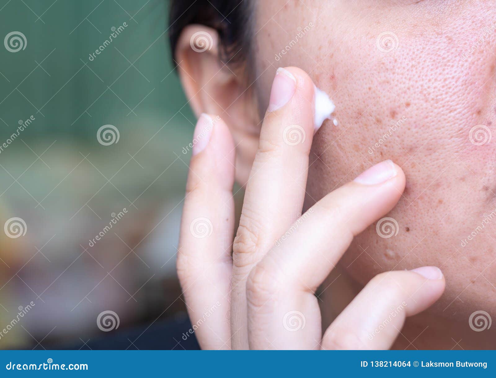 woman applying cream onto face that has problem problematic skin , acne scars ,oily skin and pore, dark spots and blackhead and