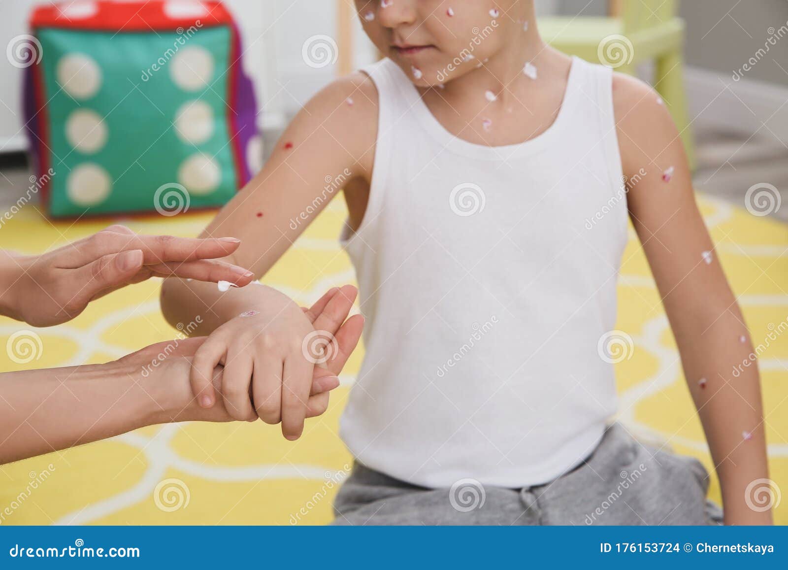 Woman Applying Cream Onto Skin of Boy with Chickenpox at Home, Closeup