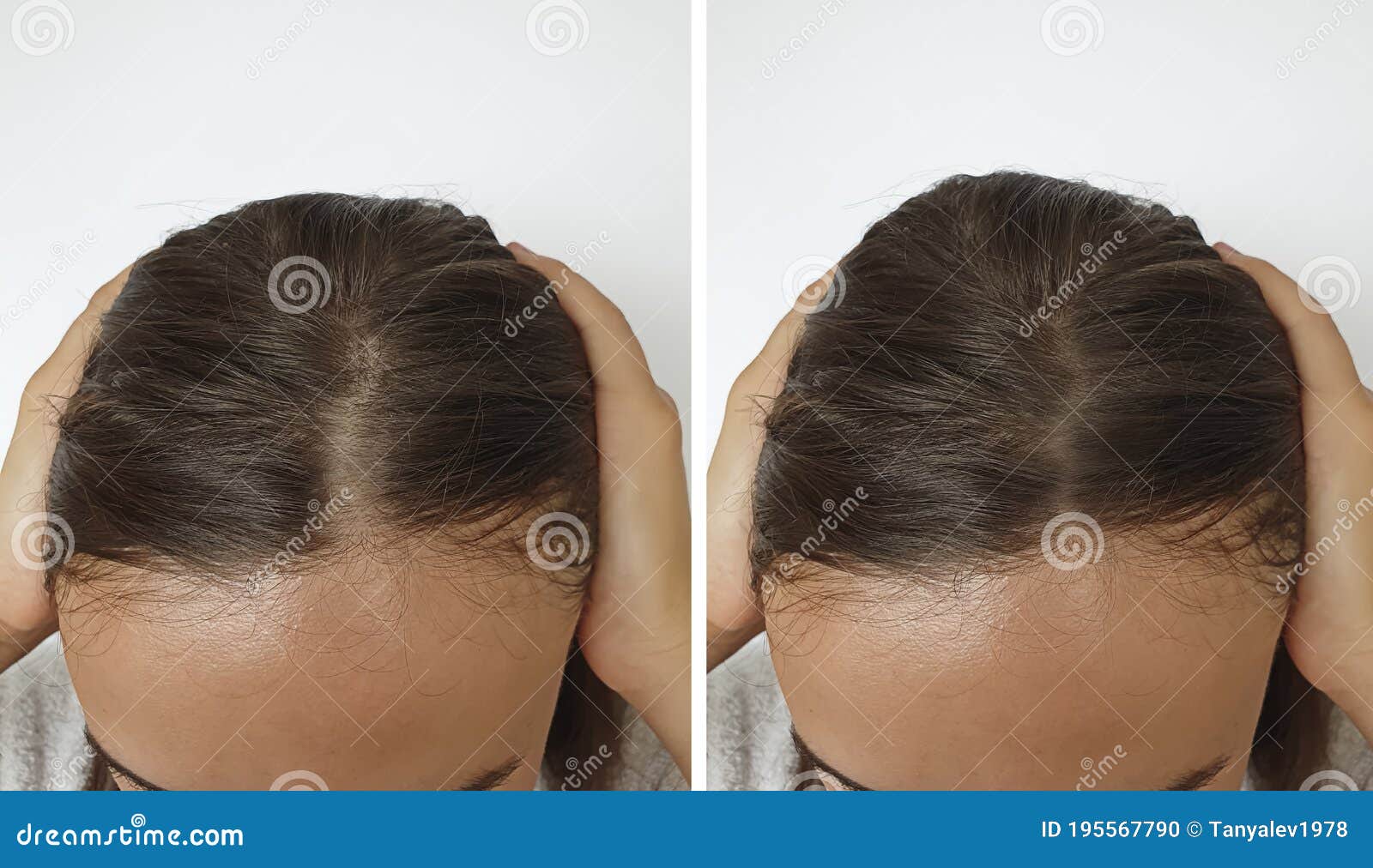 woman baldness hair before  after treatment