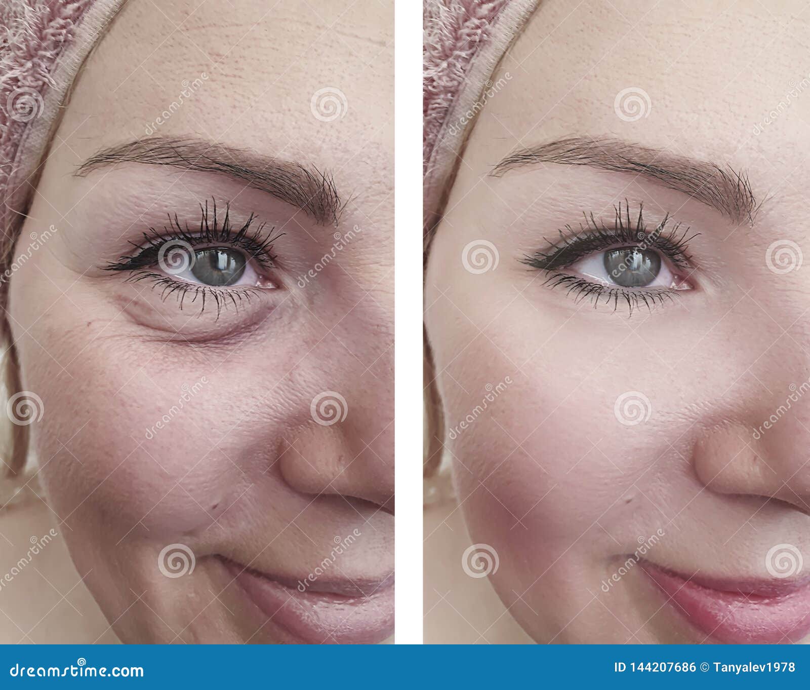 woman beauty wrinkles removal lift antiaging cosmetology before and after correction procedures