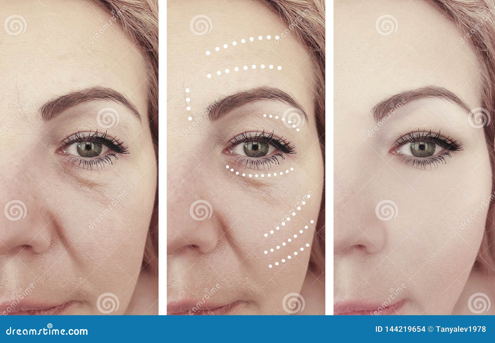 Woman Beauty Wrinkles Removal Treatment Antiaging Cosmetology Before