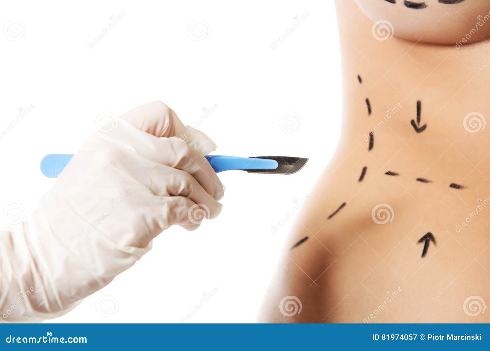 woman body marked out for cosmetic surgery.