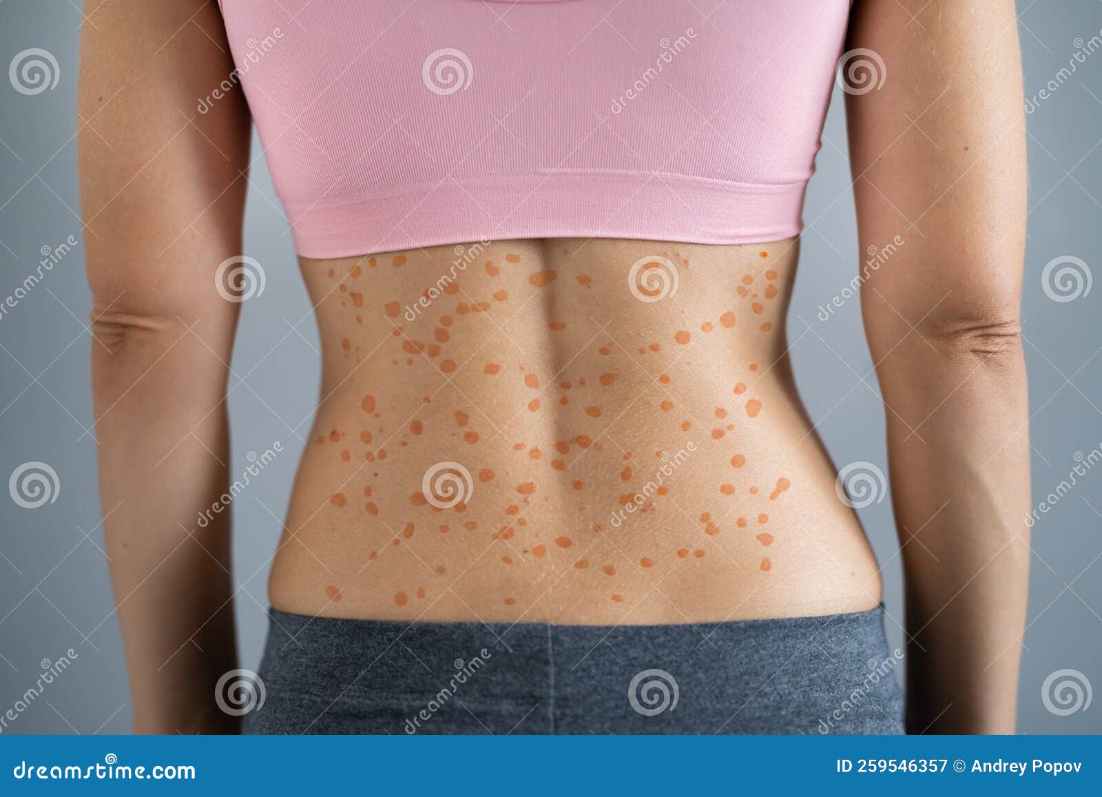 Woman Body Skin with Red Allergy Eruption Stock Image - Image of