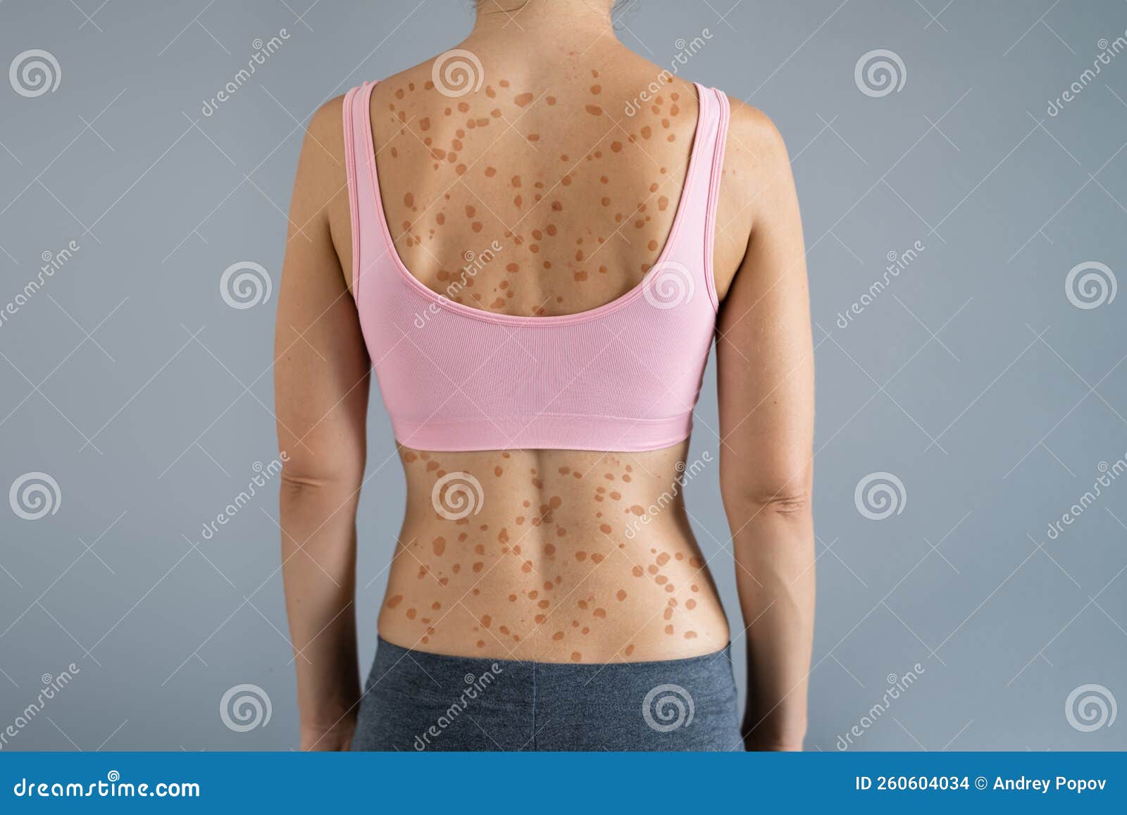Woman Body Skin with Red Allergy Eruption Stock Photo - Image of