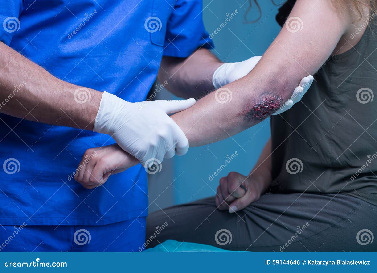 Woman with bruised elbow stock photo. Image of injury 59144646