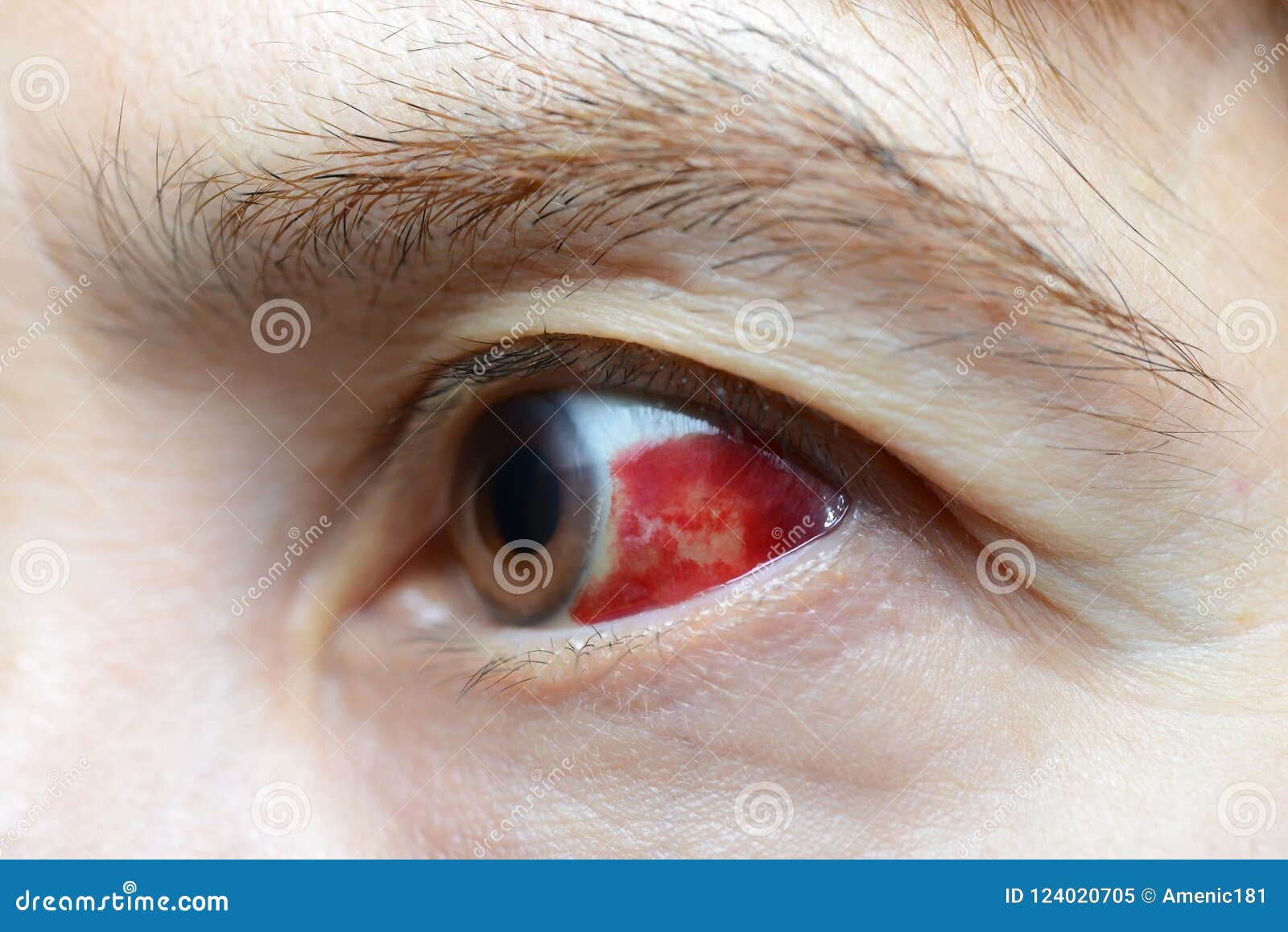Woman With Burst Blood Vessel In Eye Stock Image Image Of Face