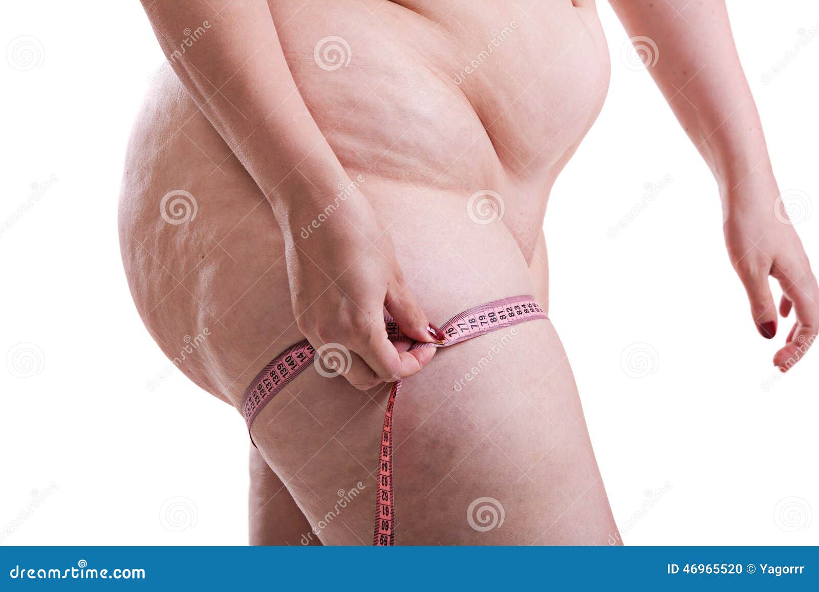 Woman With Cellulite Thighs Volume Measures Stock Photo Image Of