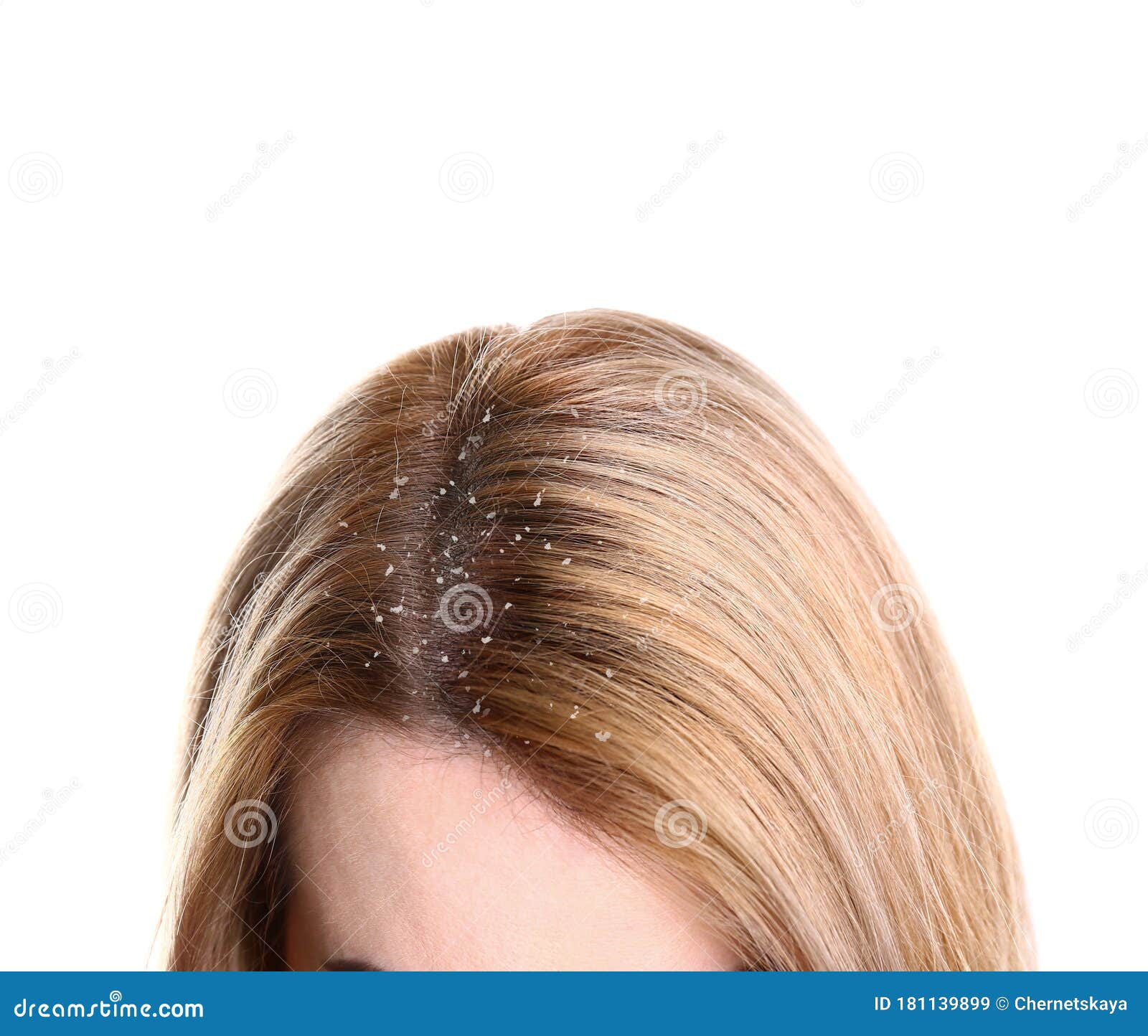 Woman With Dandruff In Her Hair On Background, Closeup Stock Image