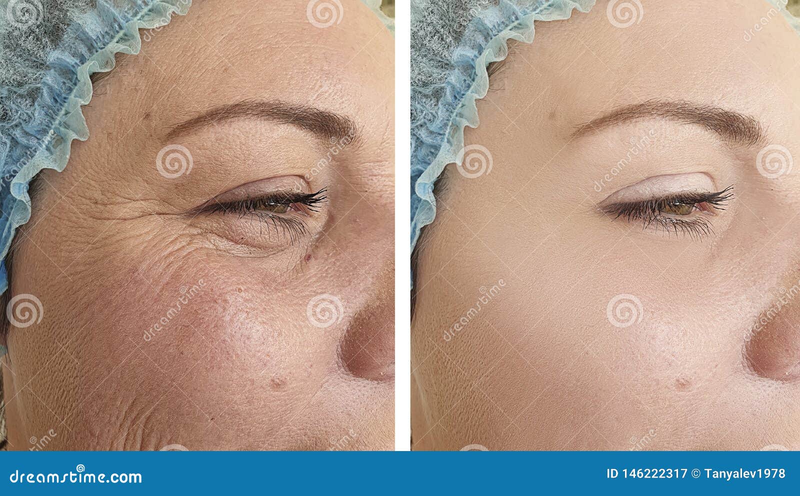 woman elderlyface wrinkles  correction before after lifting biorevitalization regeneration antiaging treatment