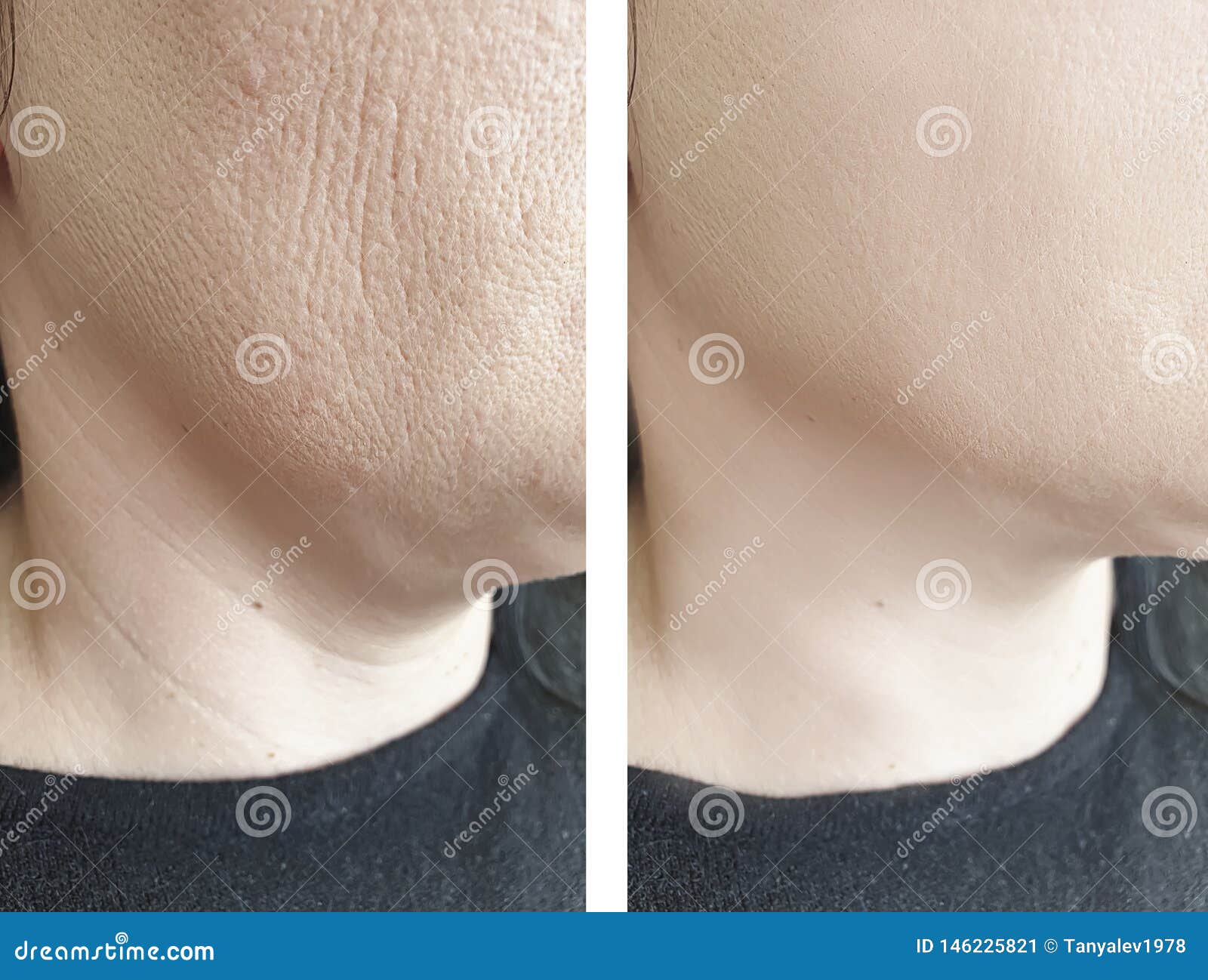 woman  elderlyface wrinkles before and after lifting biorevitalization regeneration antiaging treatment