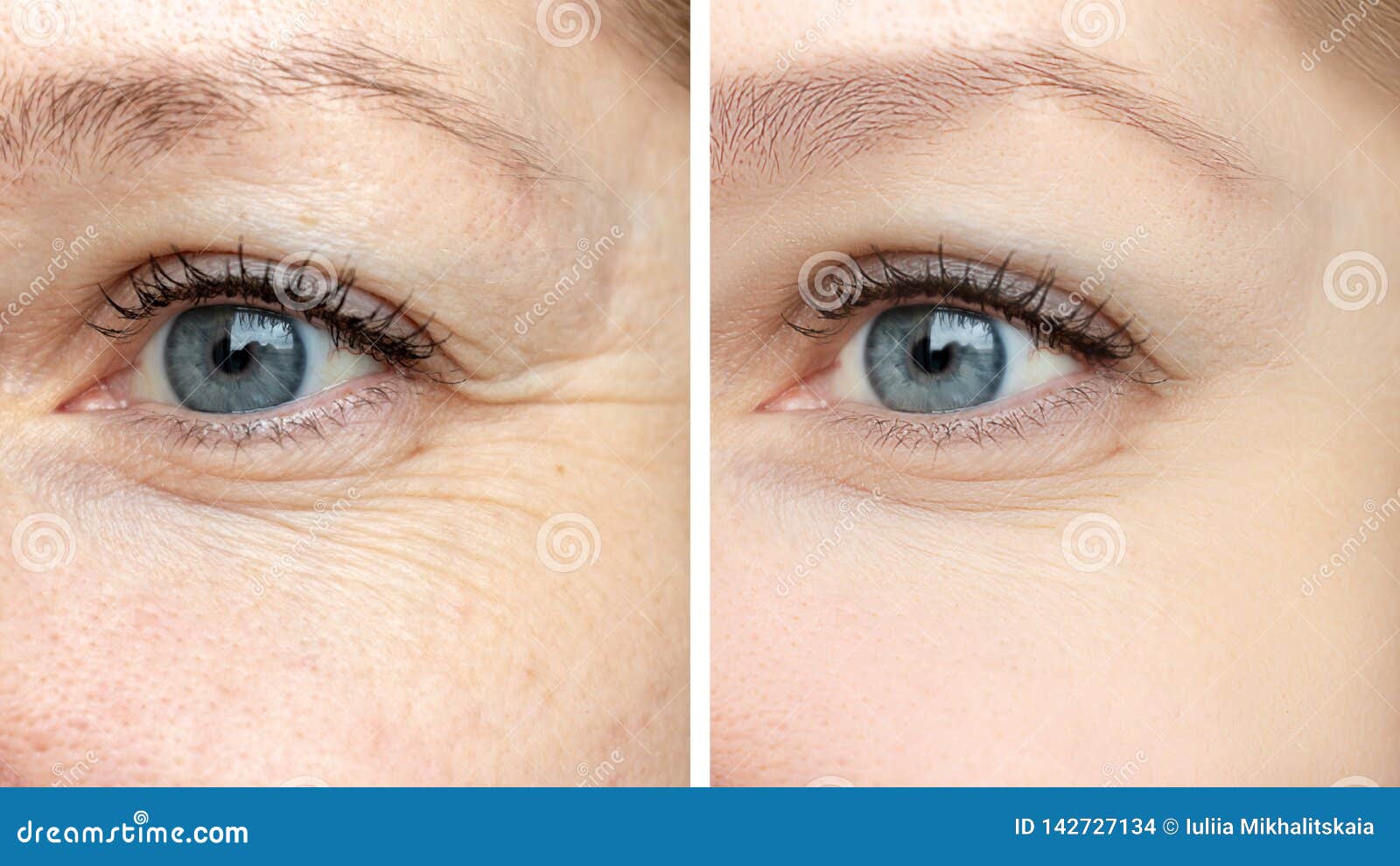 woman face, eye wrinkles before and after treatment - the result of rejuvenating cosmetological procedures of biorevitalization,