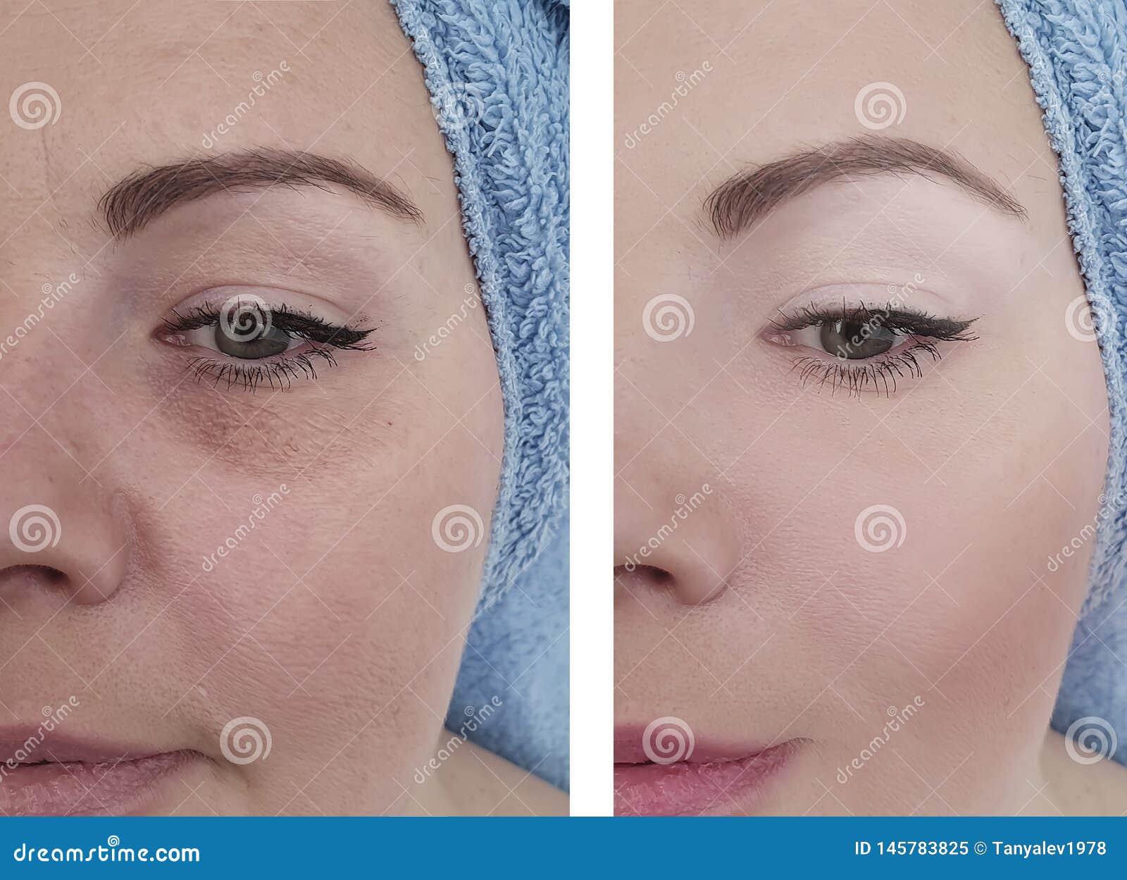 woman face wrinkles before  after rejuvenation  beautician therapy results collage  effect