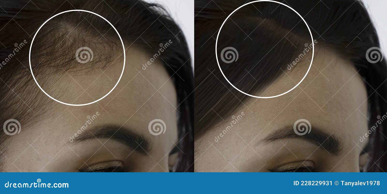 woman head baldness before and after treatment alopecia