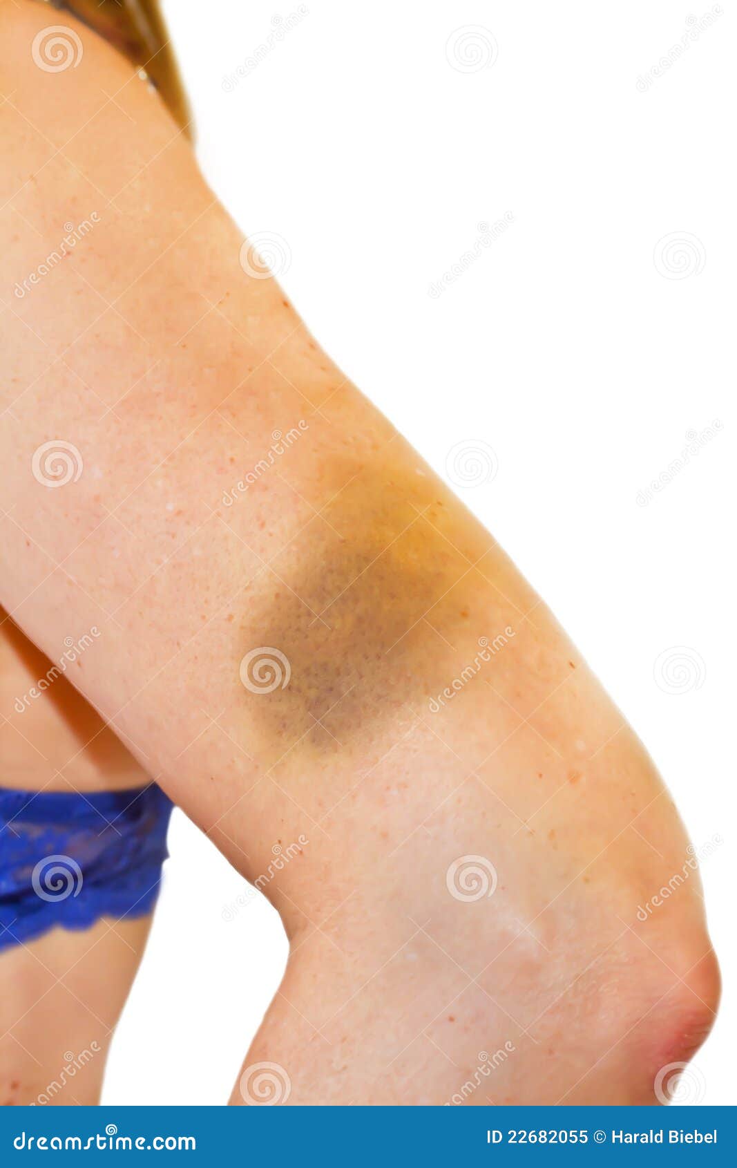 woman with a hematoma