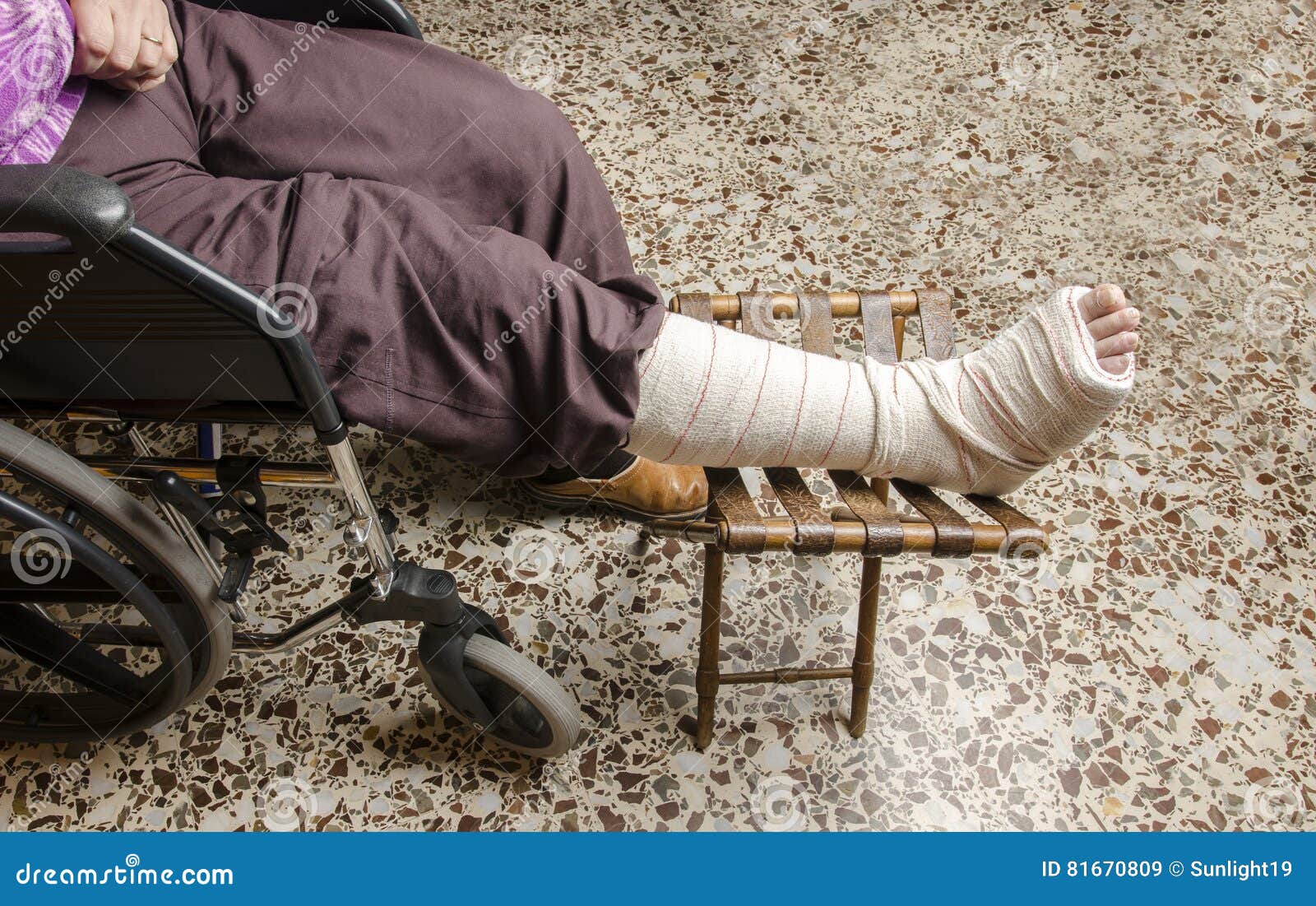 Woman with Her Broken Leg. Arm in a Cast. Stock Image Image of hurt