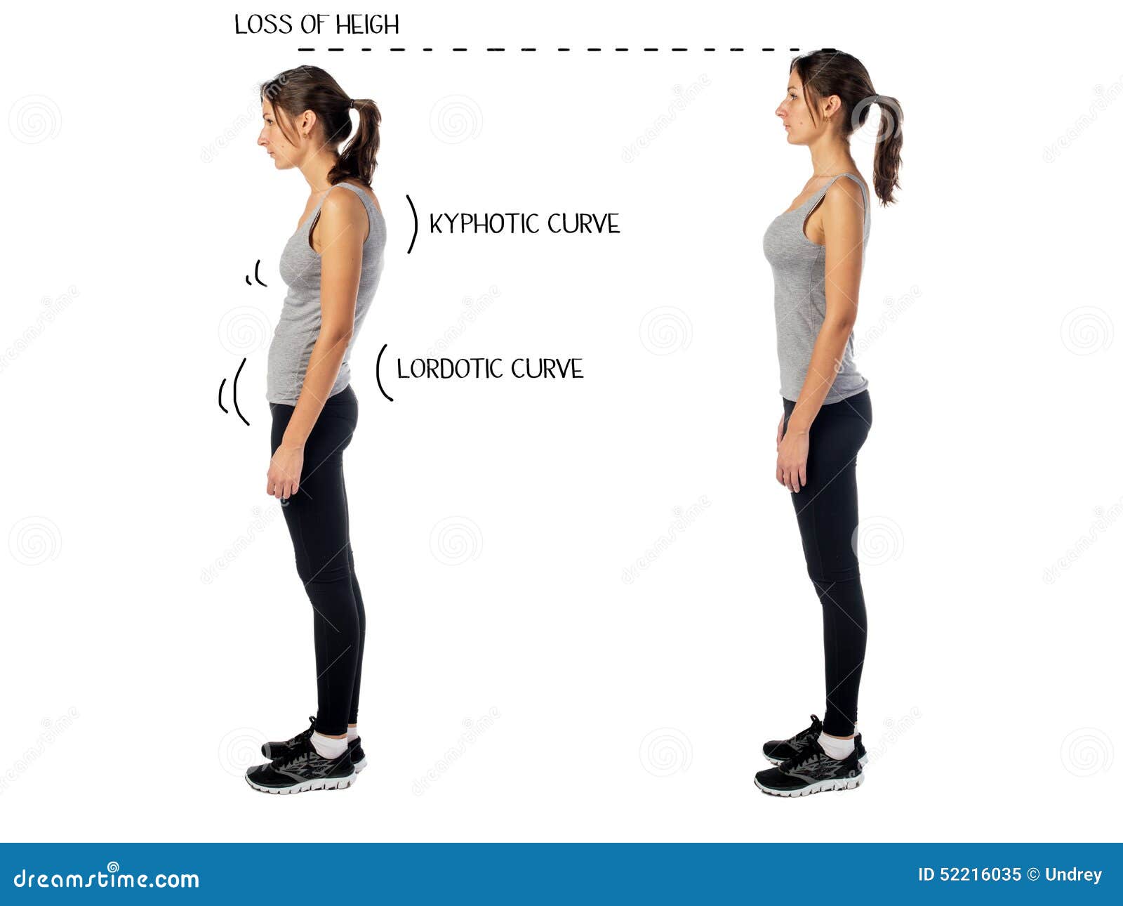 woman with impaired posture position defect