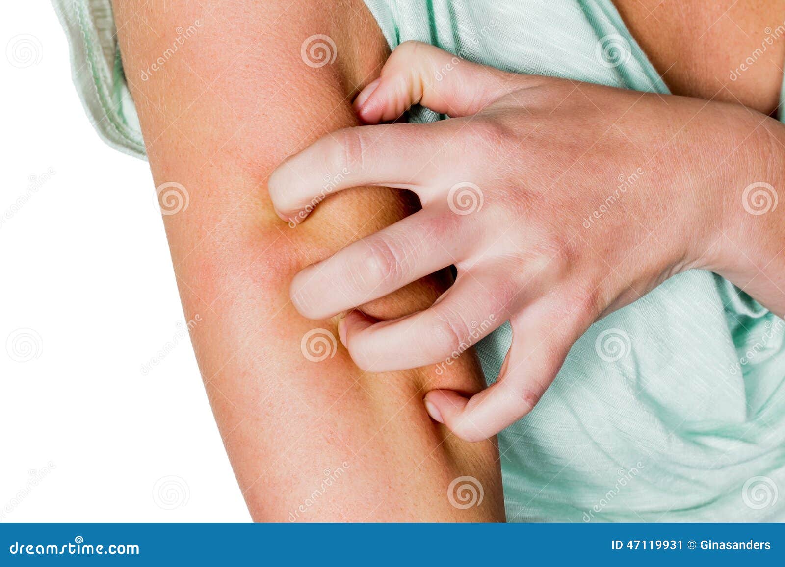 woman-itchy-skin-has-mosquito-bite-scrat