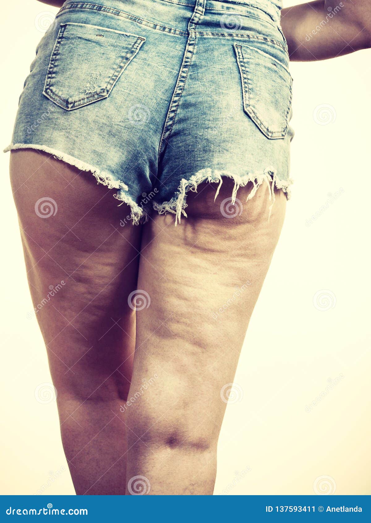 Woman Legs With Cellulite Skin Stock Image Image Of Cellulite Body 137593411