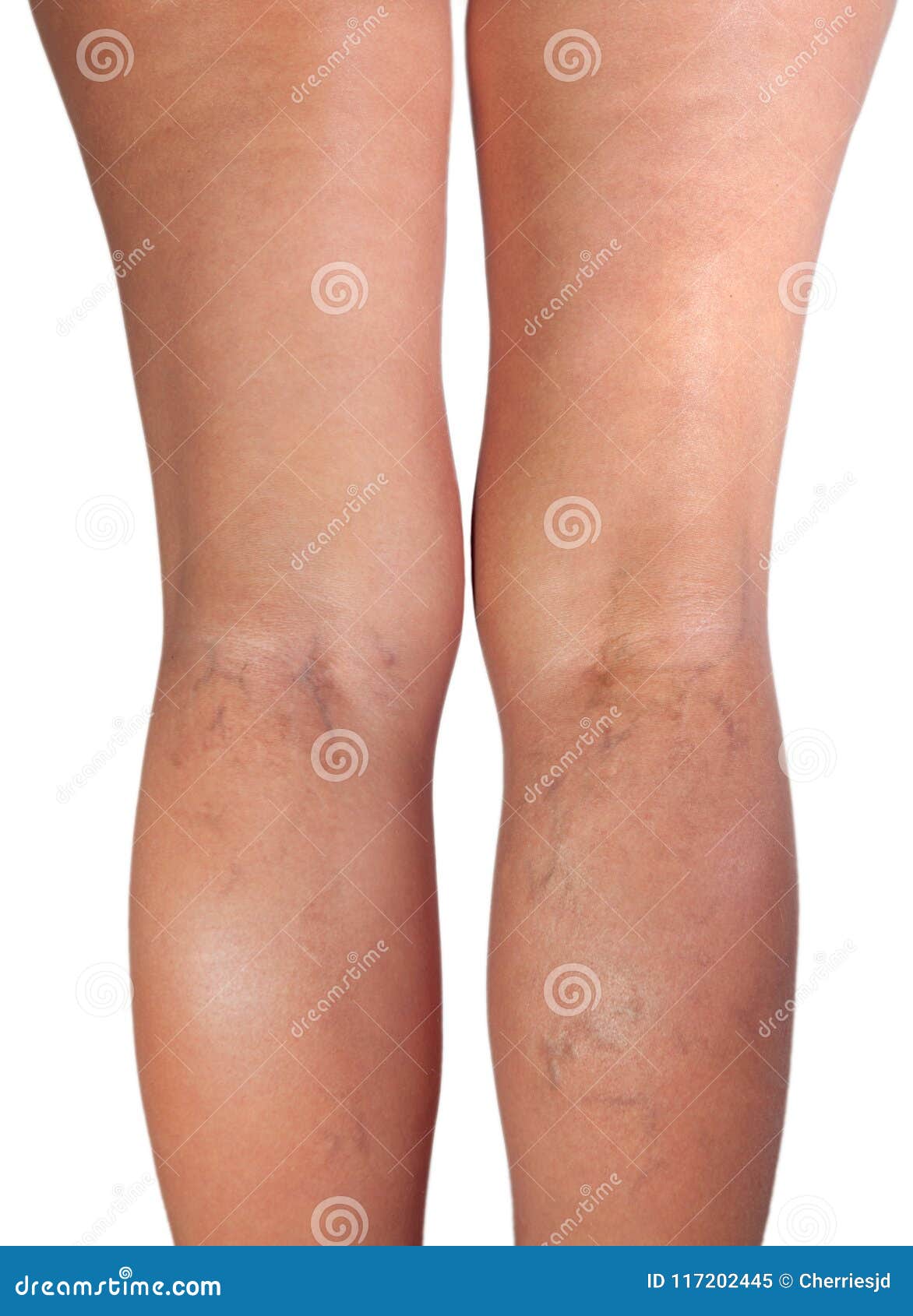 Tratamentul popular faa de picioarele varicoase