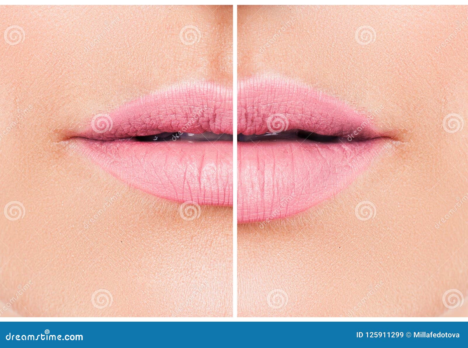 woman lips before and after lip filler injections.