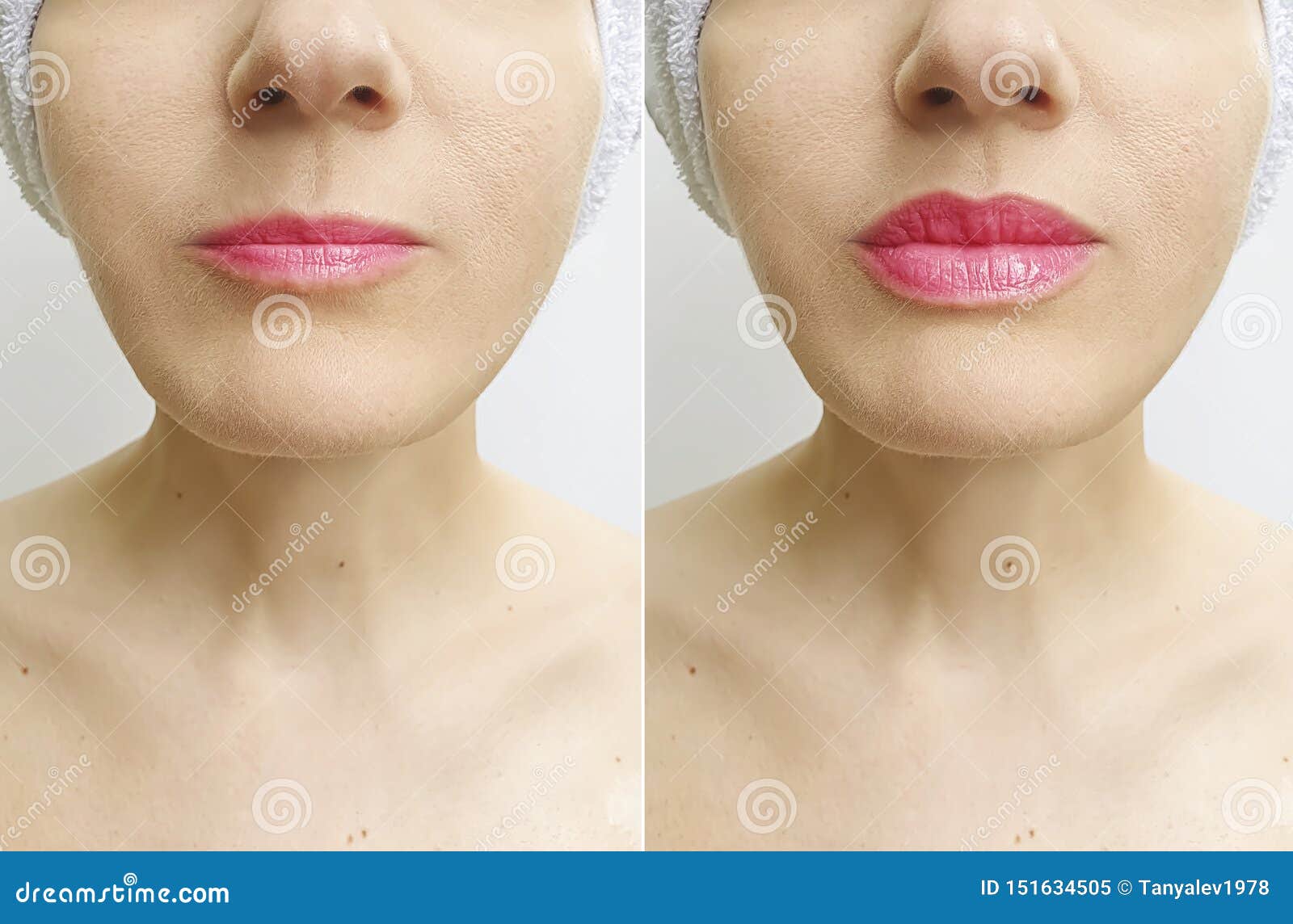 woman lips before and after perfect enhancement correction augmentation difference injection