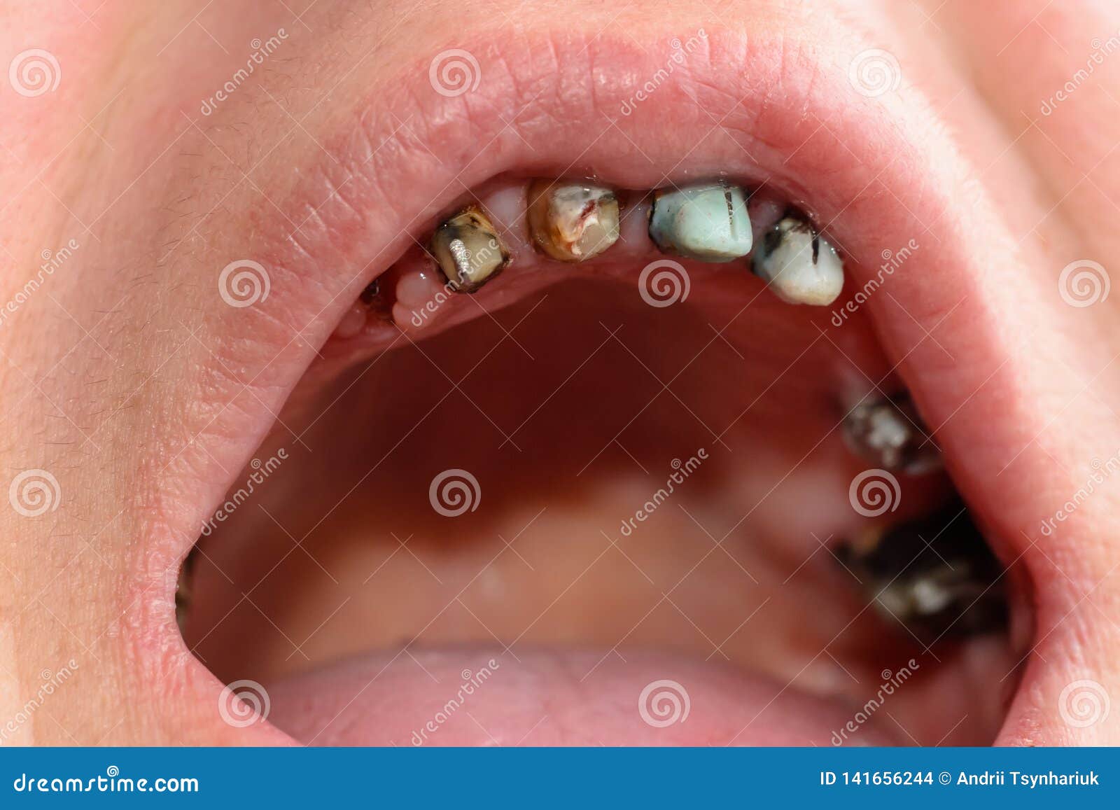 With teeth woman rotten Rotten Teeth