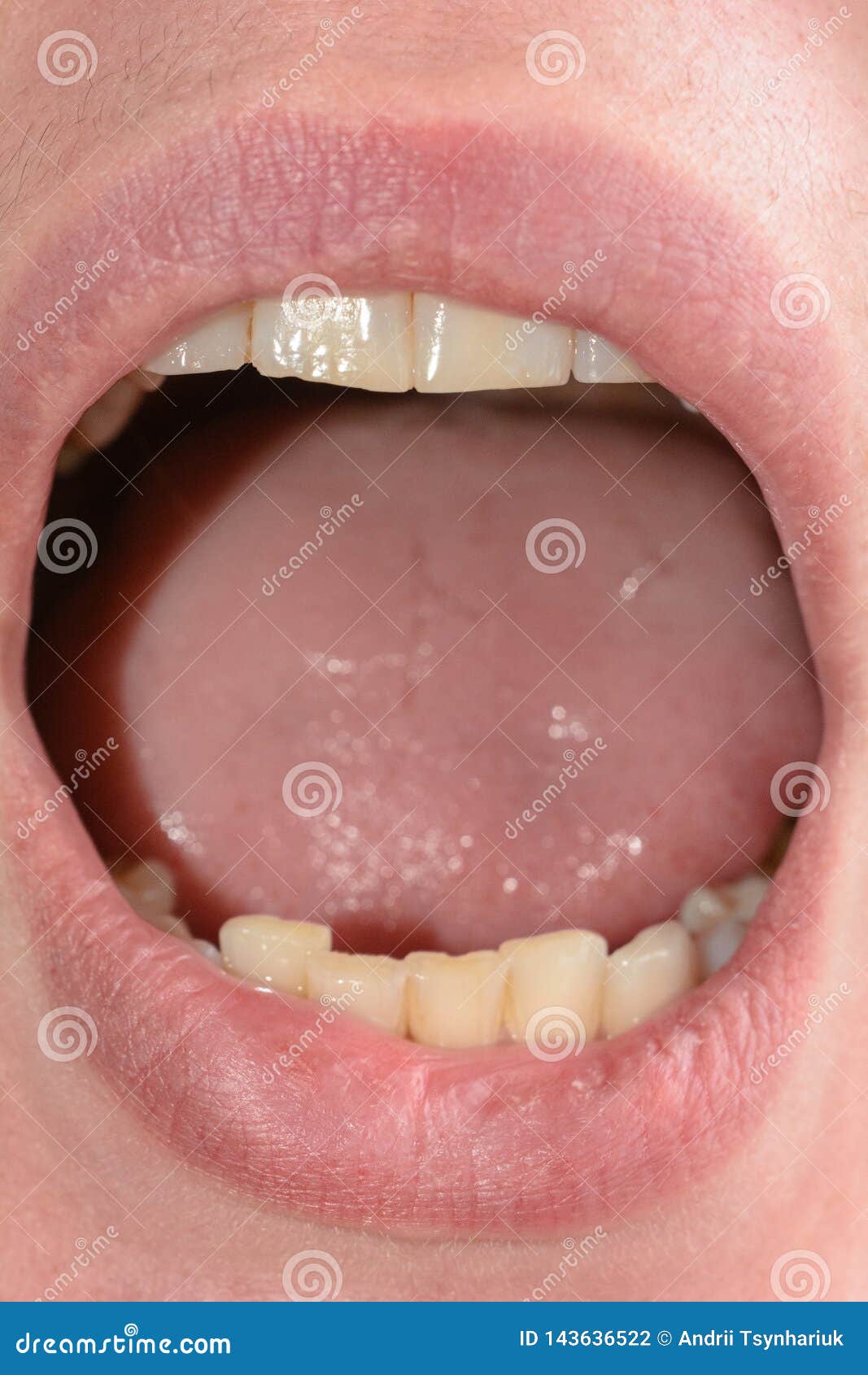 Teeth woman with rotten Queen Elizabeth’s