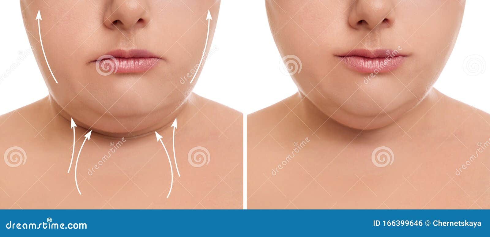 Woman Before And After Plastic Surgery On White Background Closeup