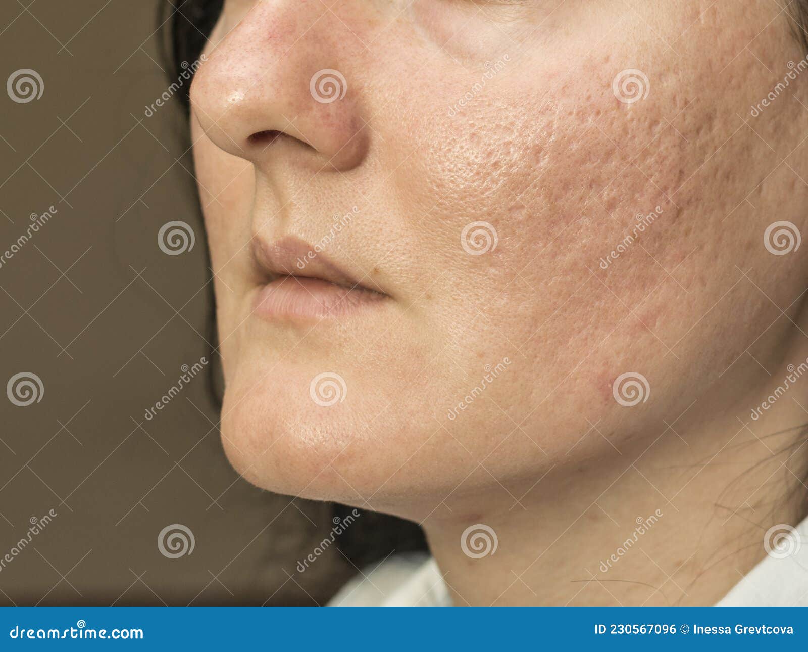 Australien værtinde Havanemone Woman with Problematic Skin and Acne Scars. Pigmentation on Face Woman.  Stock Photo - Image of girl, infection: 230567096