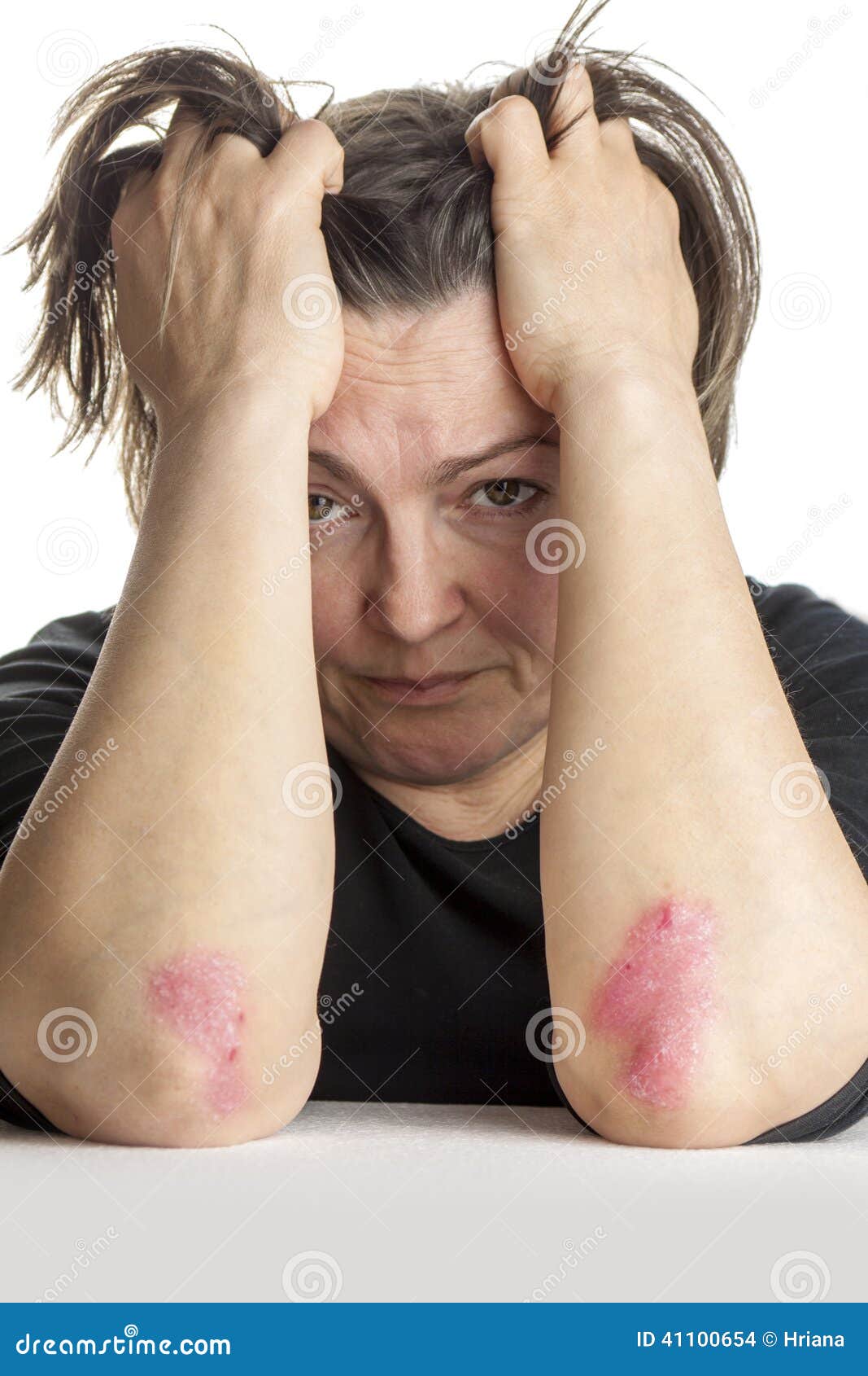 woman with psoriasis
