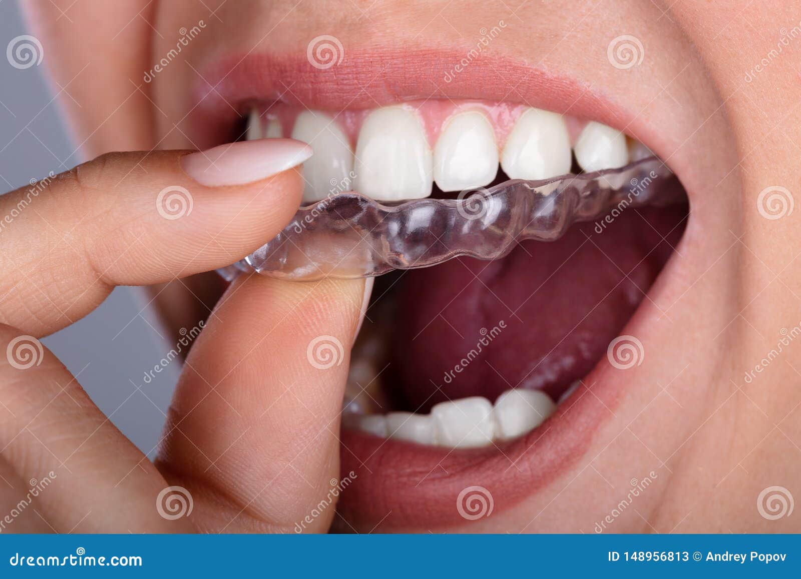 woman putting transparent aligner in teeth