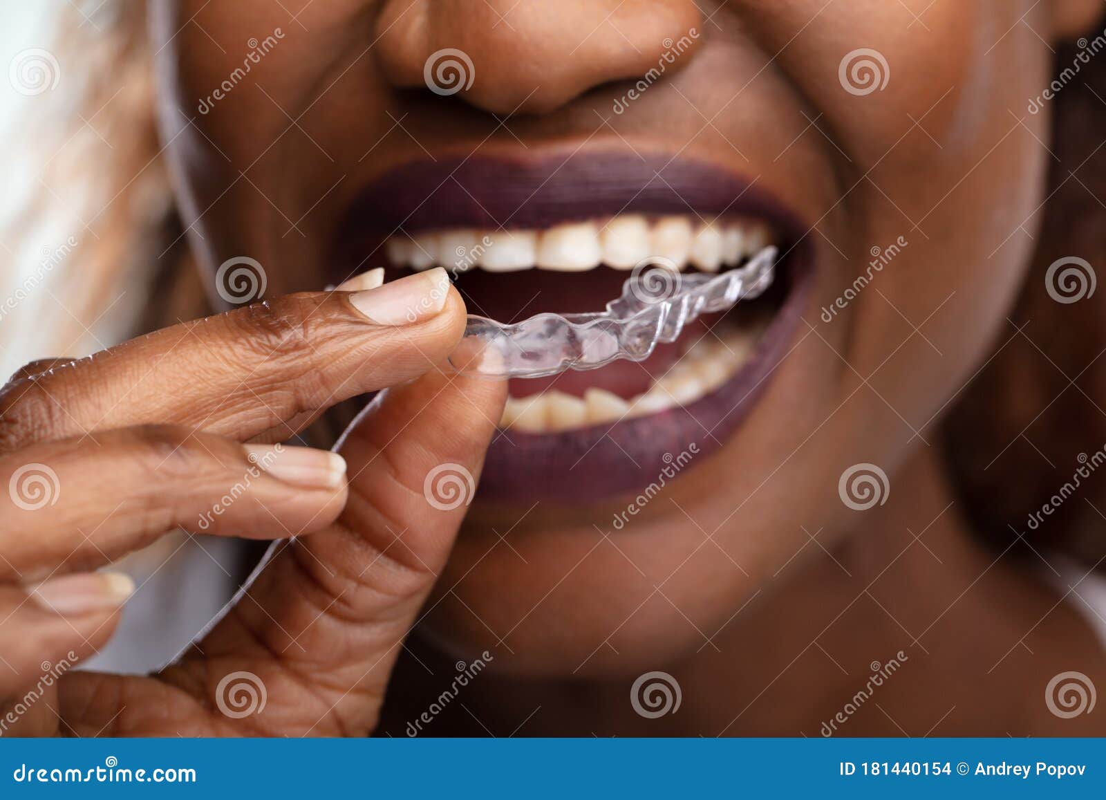 woman putting transparent aligner in teeth