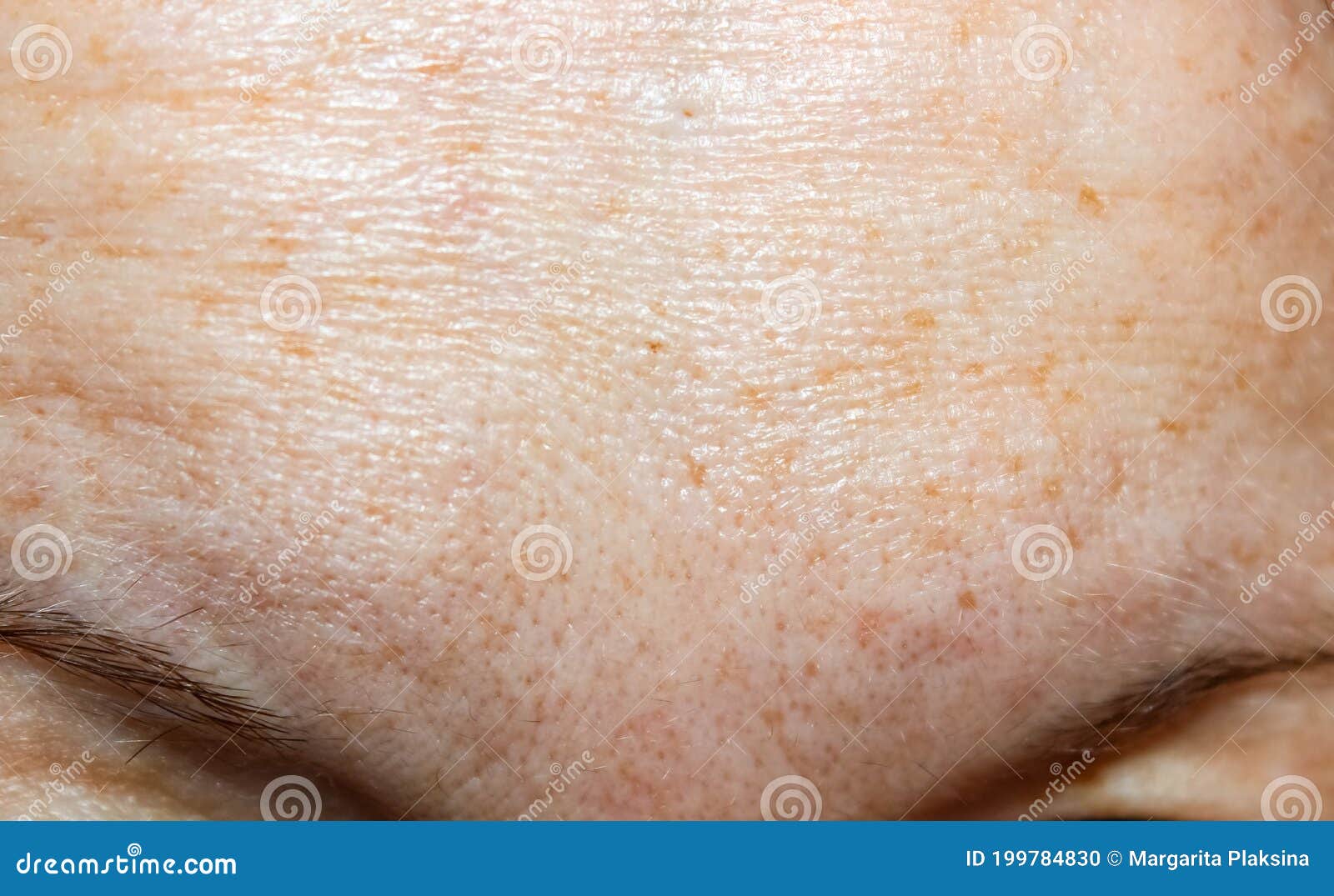 What Causes Large Pores (and can you shrink them?) - Beverly Hills MD