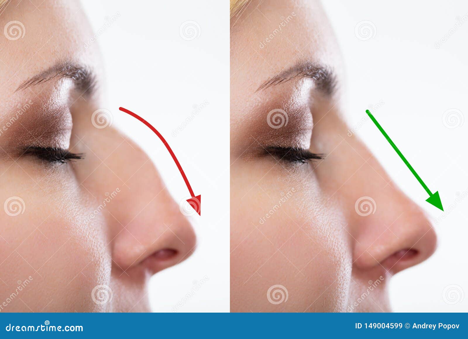 woman`s nose before and after plastic surgery