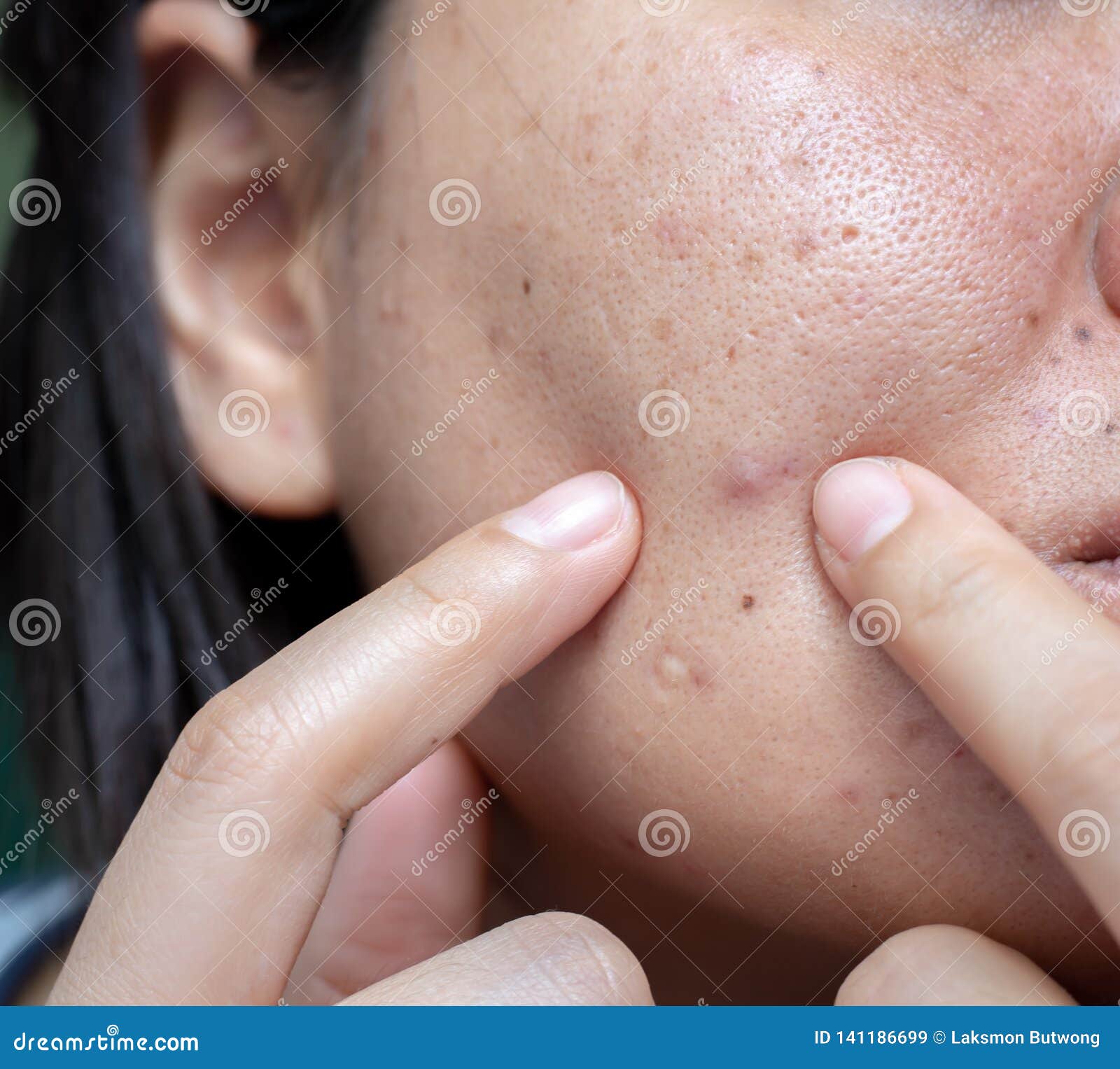 white acne scars on face